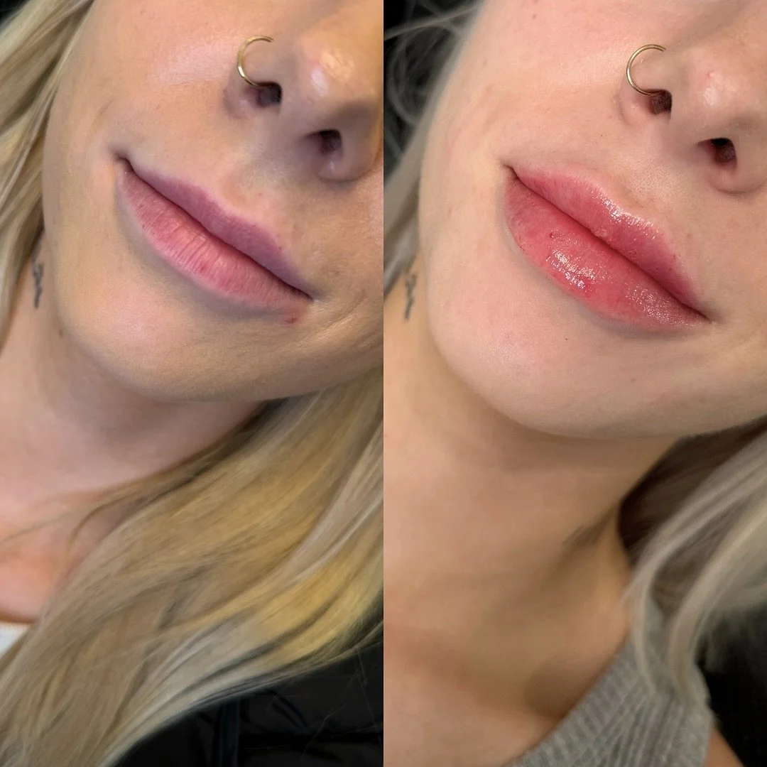 SYMMETRY ✔️
HYDRATION ✔️
VOLUME ✔️

For this cutie bride-to-be, we played the long game! 5 months from start to finish, but so worth it in the end!

First, we needed to dissolve some old migrated filler. This took 3 appointments of hyaluronidase trea