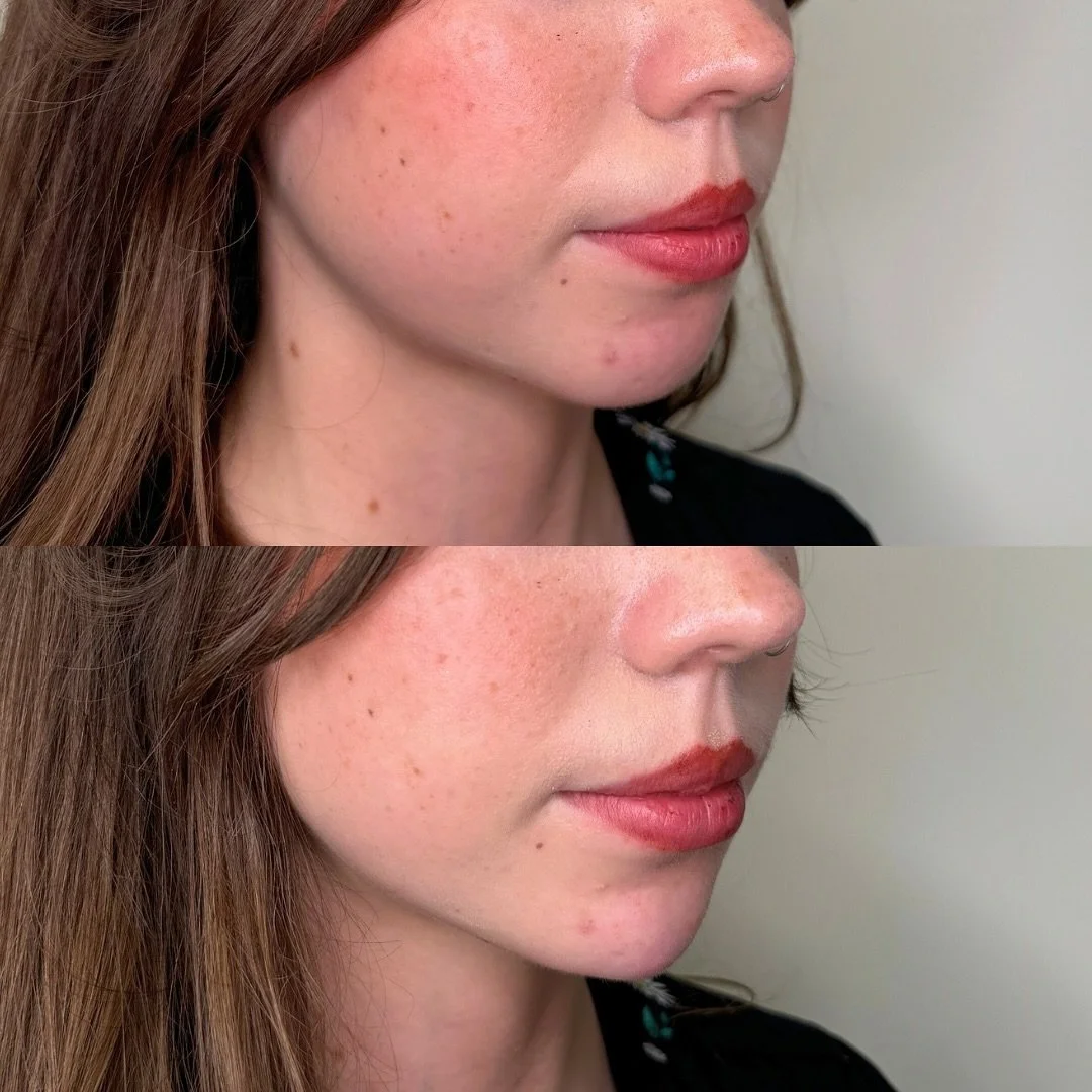 CHIN 🖤

Chin filler for this cutie pie, focusing on building projection in that side profile! 

Chin Filler | Calgary Nurse Injector | Chin Before + After | YYC Beauty | Botox + Filler | Frida Beauty Bar | Franks by Frida