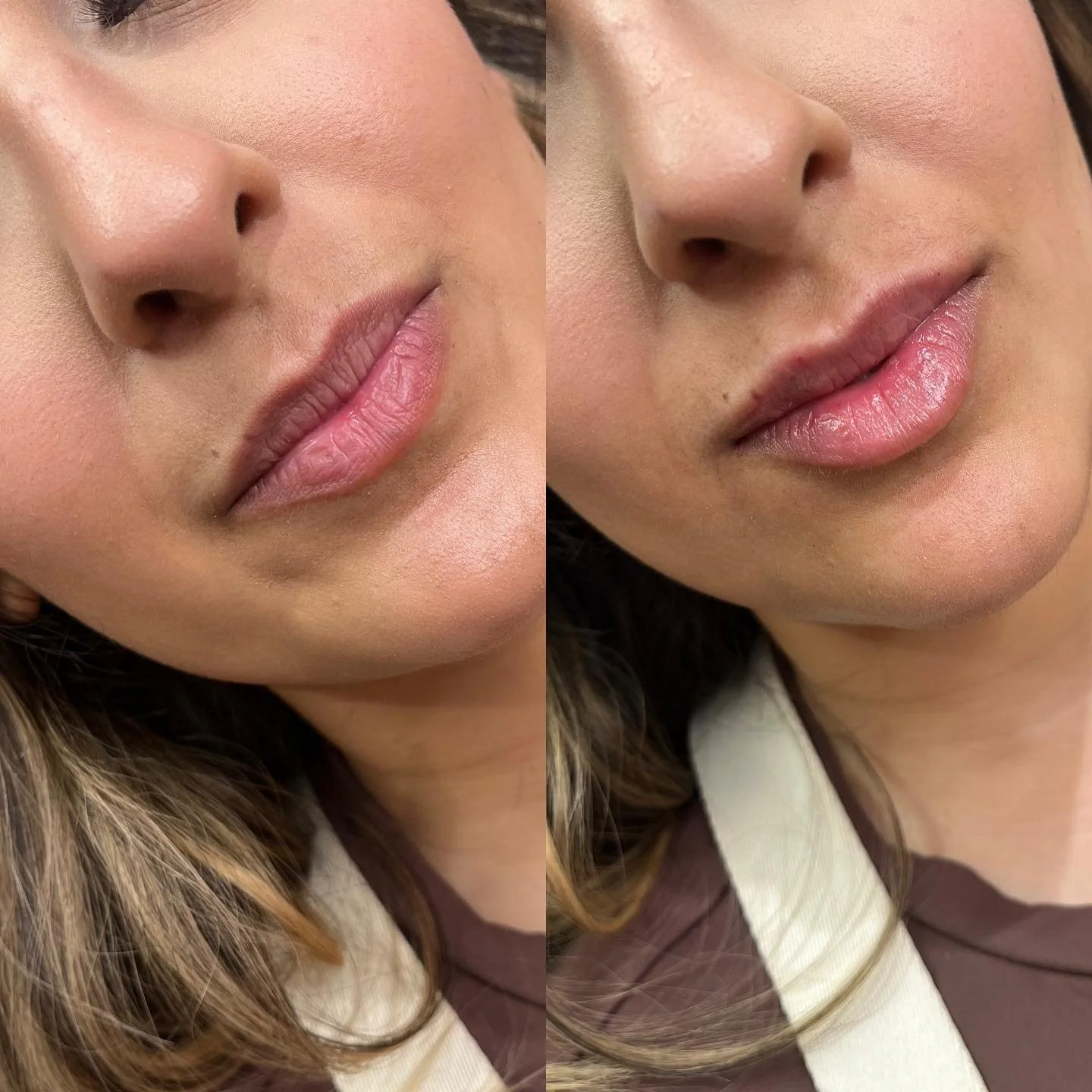 👄LIPS👄 
Subtle refresh for this gals first time! 
⏰ Appointment time: 30 minutes 
💉 Product: Half syringe Restylane Kysse 
⌛️ Duration: 6-9 months 
👄 Common side effects: Bruising and swelling at injection site 
😬Pain level: 3/10 with numbing
