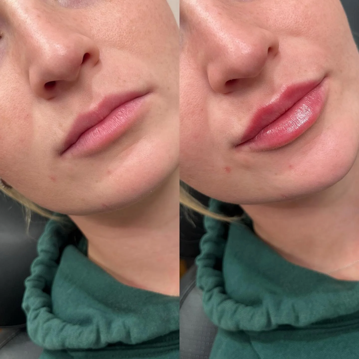 👄LIPS👄 
This beautiful client was fresh off some dissolving of migrated filler (folks, it happens…more often than you think).
 
We decided to keep her natural ratio of a bigger bottom lip. What a gorgeous canvas to work on! 💋
⏰ Appointmen