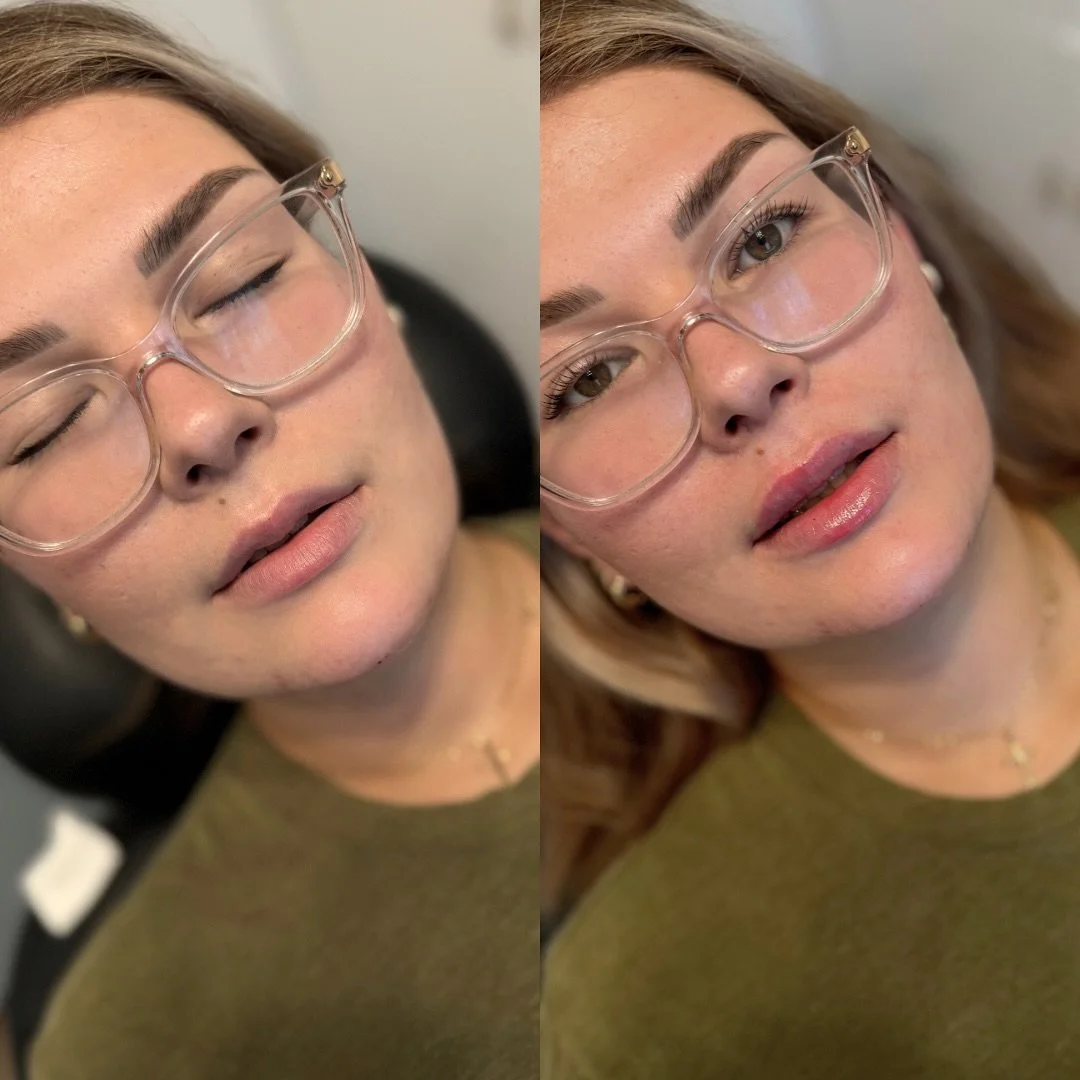 Say hello to our GIVEAWAY WINNER!! Sweet as sugar and so deserving 🧡 

We had a full syringe to work with and decided to split the product - half lips, half chin - to enhance her already beautiful features. She&rsquo;s never had filler!!

First up, 