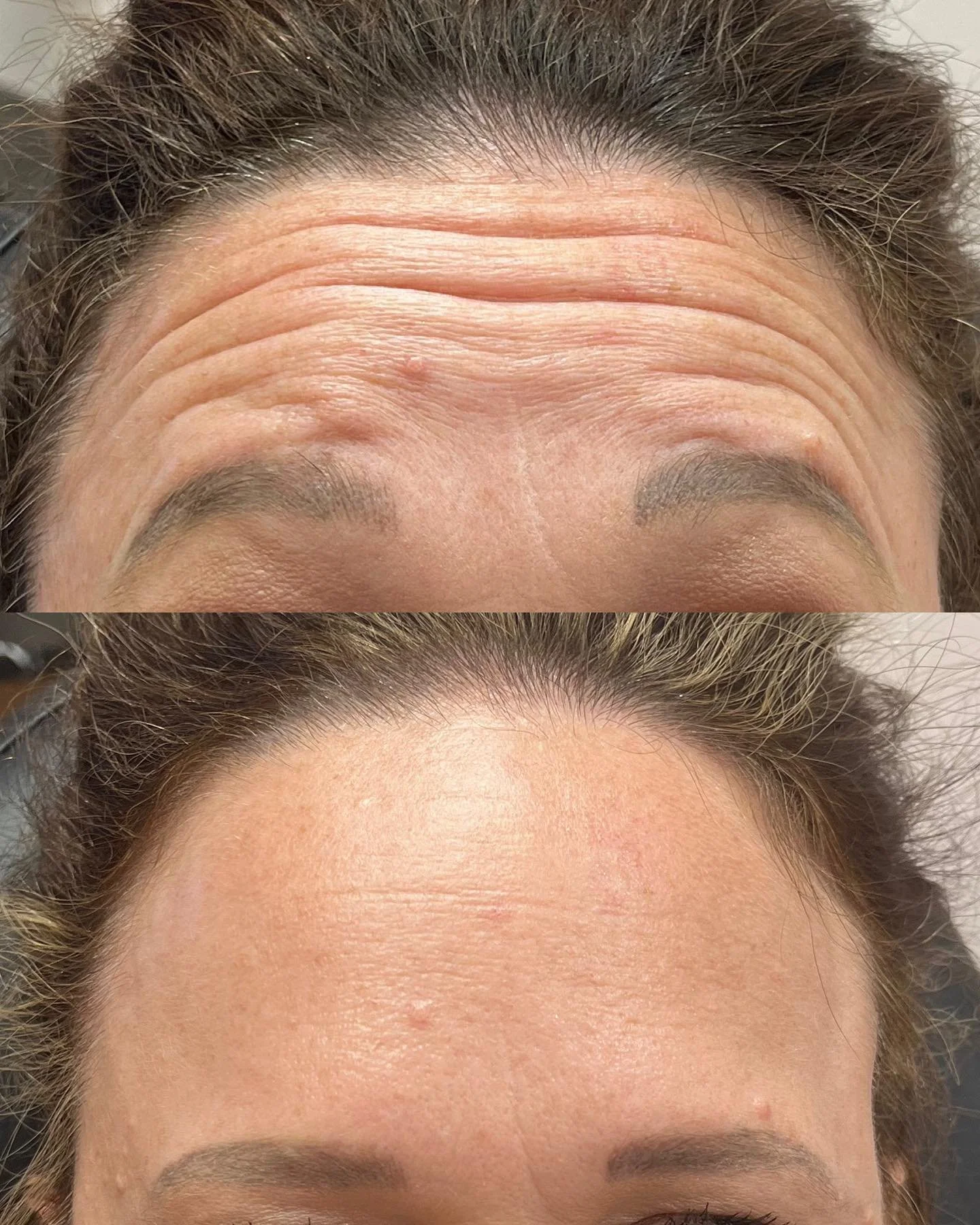 ✨Forehead & Furrow Dysport✨
What an incredible result for my darling client. Over time, with regular treatment every 3-4 months her lines will continue to soften. 
⏰ Appointment time: 15-30 minutes 
💉 Product: Dysport
⌛️ Duration: 3-4 months
?