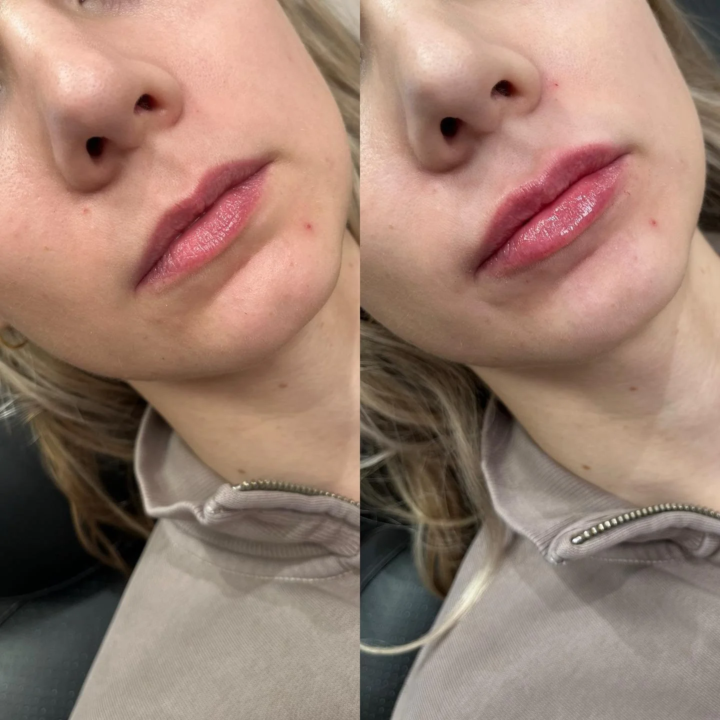 👄LIPS👄 
⏰ Appointment time: 30 minutes 
💉 Product: Half syringe Restylane Kysse 
⌛️ Duration: 6-9 months 
👄 Common side effects: Bruising and swelling at injection site 
😬Pain level: 5/10 with numbing cream
📍Location: Frida Beauty Bar - Mardal