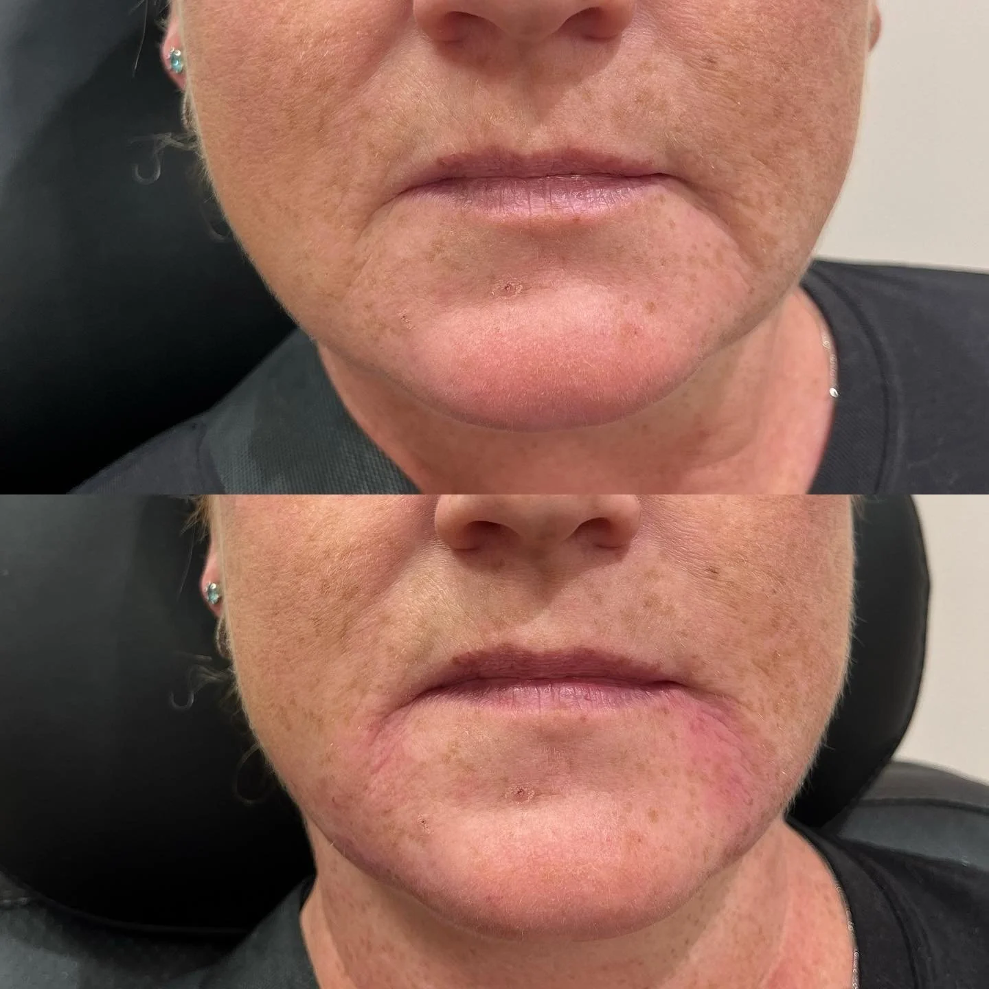 ✨MARIONETTE LINES✨
Marionette lines are often a concern as we age. A combination of gravity, repetitive facial expressions, loss of volume and elasticity of the skin all contribute to this issue. 
For this lovely client we added a half syringe of H