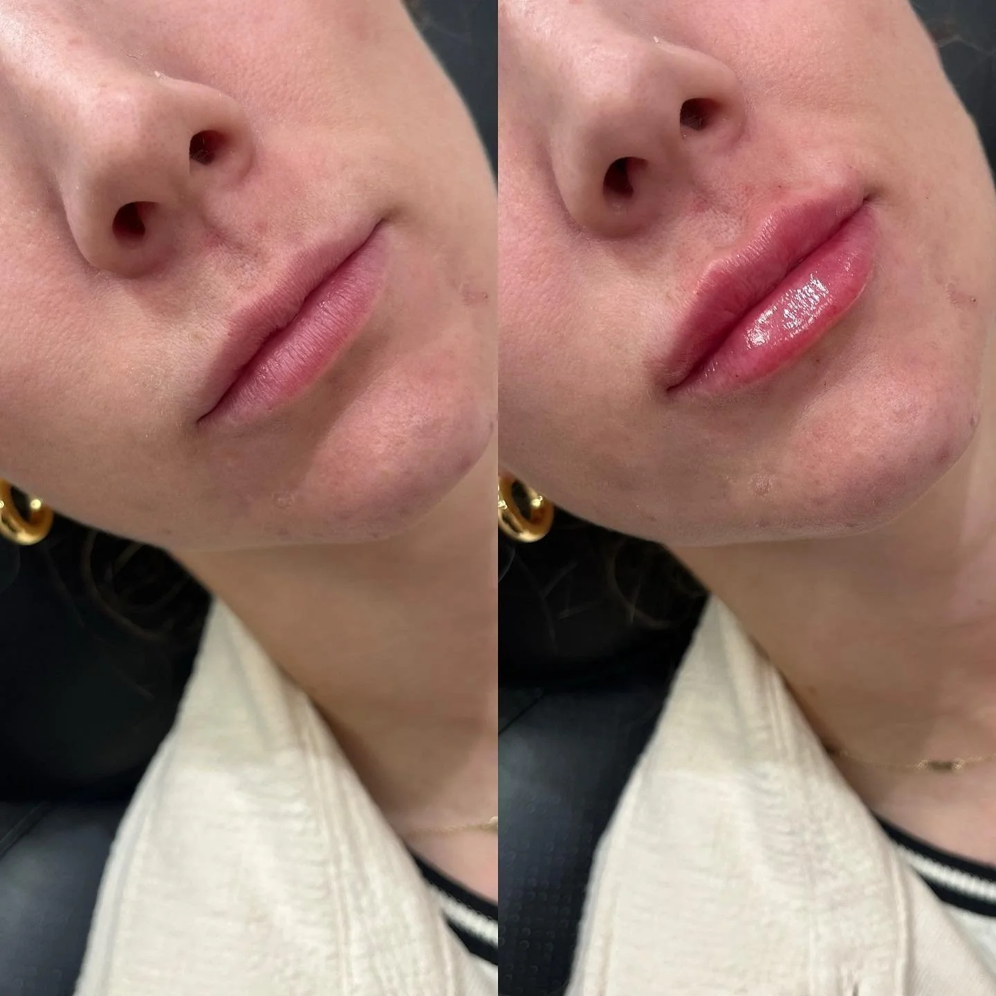 👄LIPS👄 
Building these gorgeous lips half syringe at a time! 
⏰ Appointment time: 30 minutes 
💉 Product: Half syringe Restylane Kysse 
⌛️ Duration: 6-9 months 
👄 Common side effects: Bruising and swelling at injection site 
😬Pain level: 5/10 w