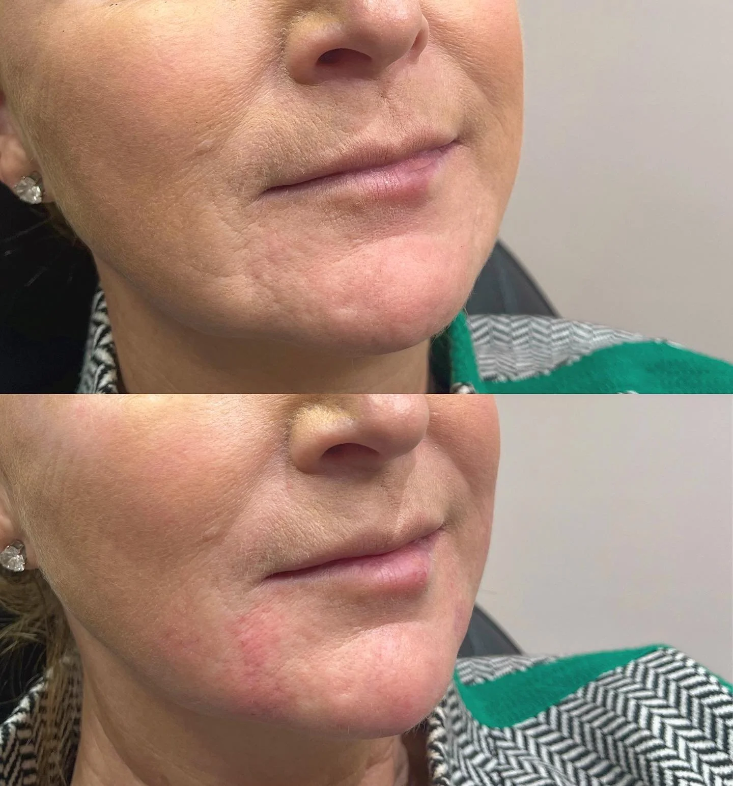 ✨ LOWER FACE REJUVENATION✨
Combination treatment of nasolabial folds, marionette lines, prejowl sulcus and chin. We also treated some superficial old acne scaring that will continue to soften over the next 2-3 weeks. 
This client received full face