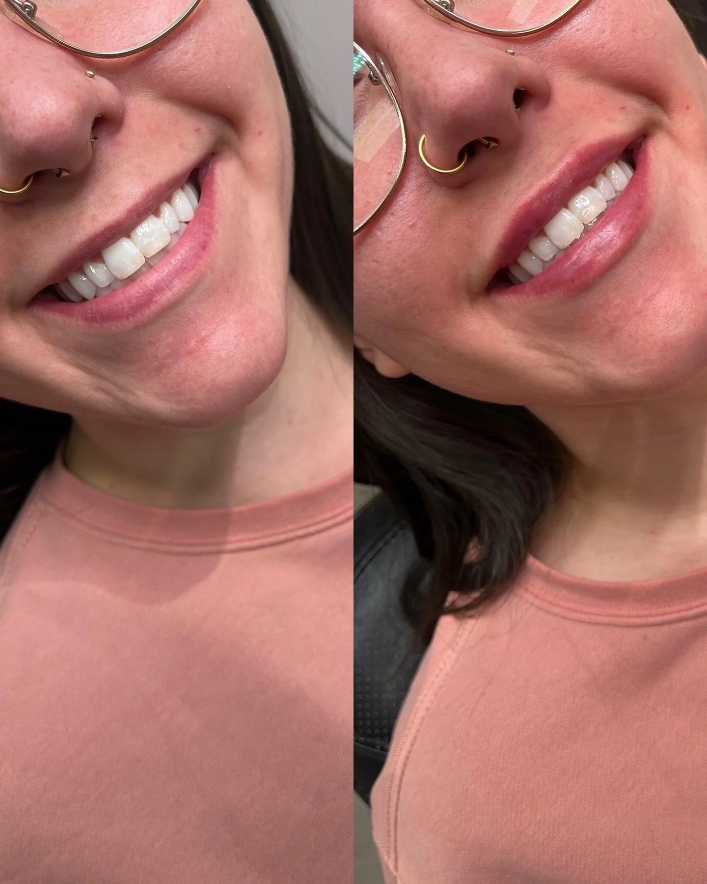 👄LIPS👄 
The prettiest peach! Working slowly to build this upper lip! First round complete and what a difference already! 
⏰ Appointment time: 30 minutes 
💉 Product: Half syringe Restylane Kysse 
⌛️ Duration: 6-9 months 
👄 Common side effects: B