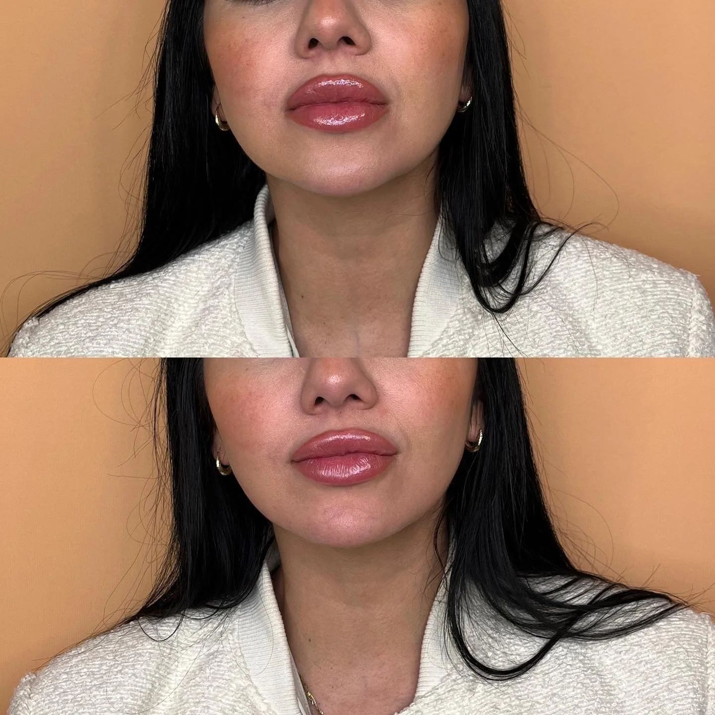 ✨CHIN & PRE JOWL SULCUS✨
A little chin for the win! 
This stunning client of mine was looking for slight length and projection to her chin and I recommended the pre jowl sulcus to ease the transition between the chin and jaw line. The outcome w
