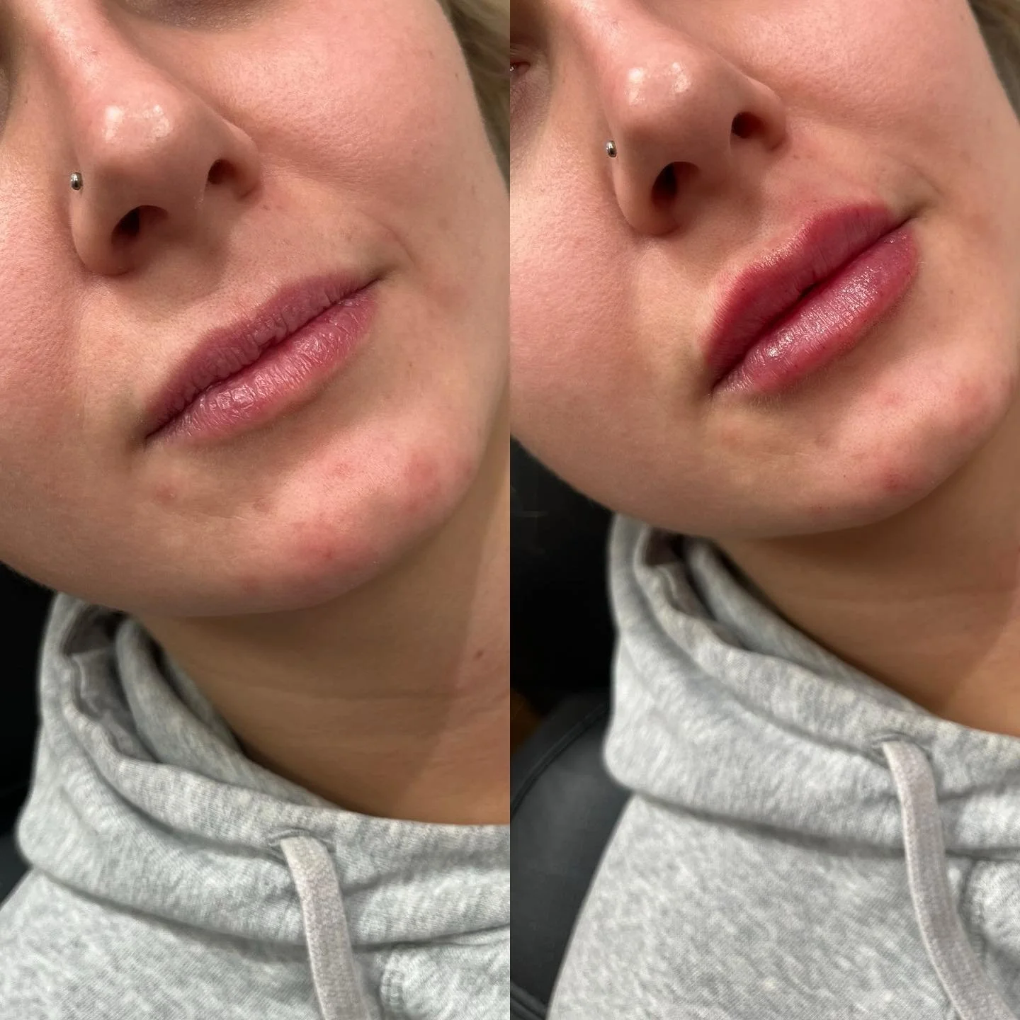 👄LIPS👄 
My beautiful client previously had a half syringe of filler in her lips 1 year ago and at the time felt like she wanted more volume once the swelling settled. We decided to do a full syringe at this appointment and it did not disappoint!