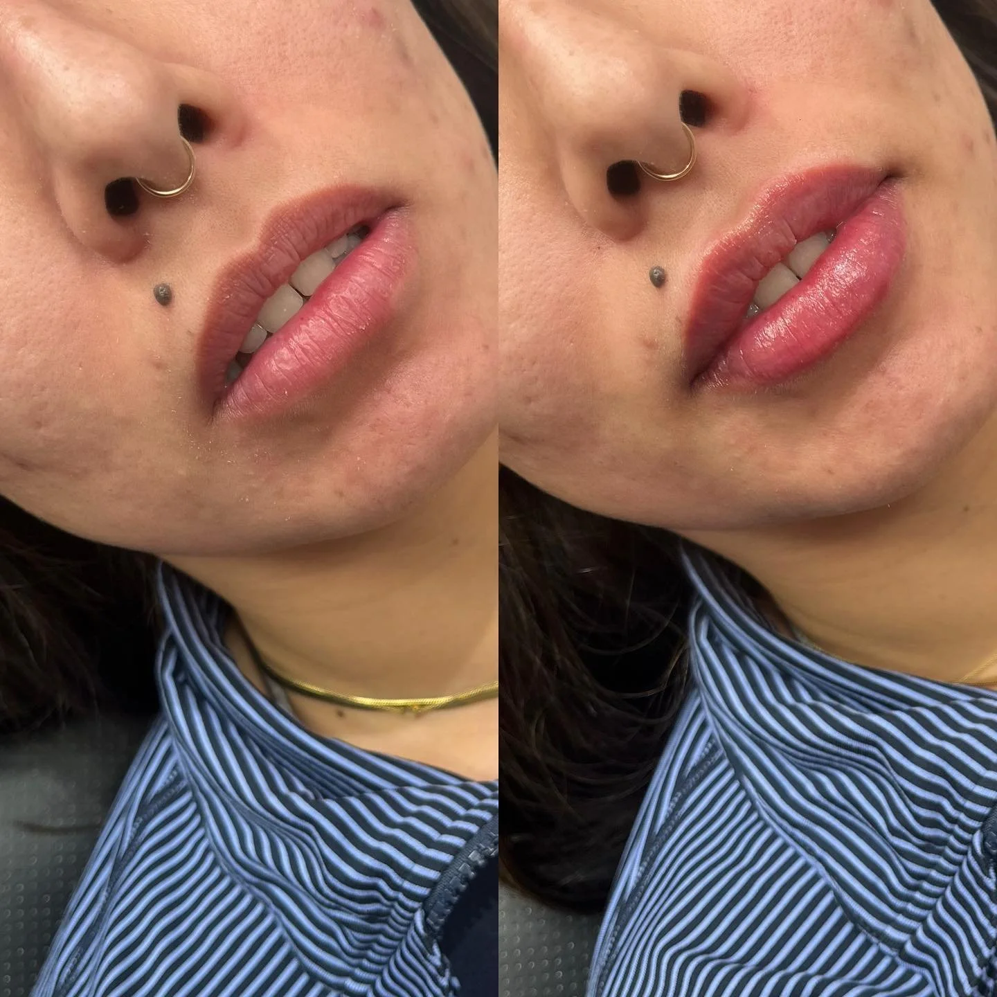 👄LIPS👄 
Upper lip: symmetry ☑️
Lower lip: volume ☑️
⏰ Appointment time: 30 minutes 
💉 Product: Half syringe Restylane Kysse 
⌛️ Duration: 6-9 months 
👄 Common side effects: Bruising and swelling at injection site 
😬Pain level: 4/10 with numbin
