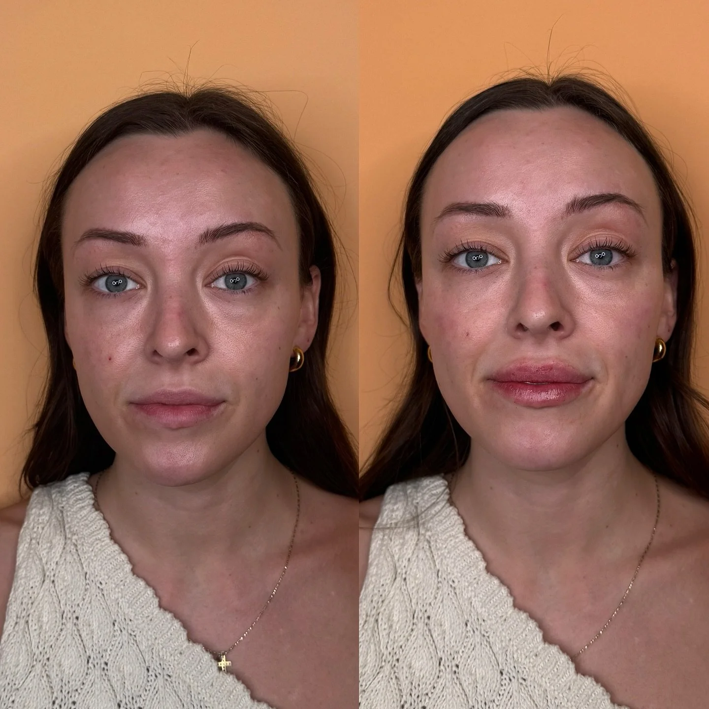 Subtle volume, major impact (all with a touch of cheek &amp; lip filler)✨💉

As we age, we naturally lose volume in our cheeks, which can lead to deeper nasolabial folds and an overall tired appearance. By restoring structure in the midface and addin