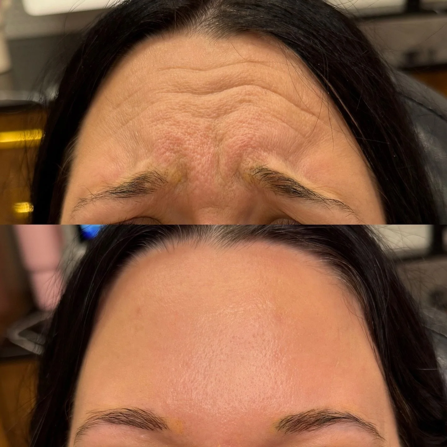 Name something better than a smooth forehead&hellip;. 😏 

I love a good forehead moment; but let&rsquo;s not forget about that lower face 👏🏻 

We are now officially 4 (!!!) weeks out from Stampede! If you were thinking about getting a treatment no