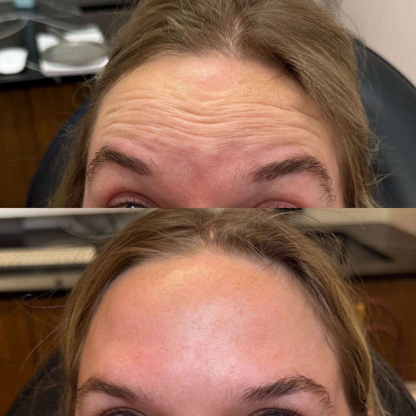 Smooth, refreshed, and confidently you!

Botox softens fine lines, relaxes wrinkles, and gives your skin that youthful glow ✨
.
.
.
.
#yycbotox #yycfiller #botox #antiaging