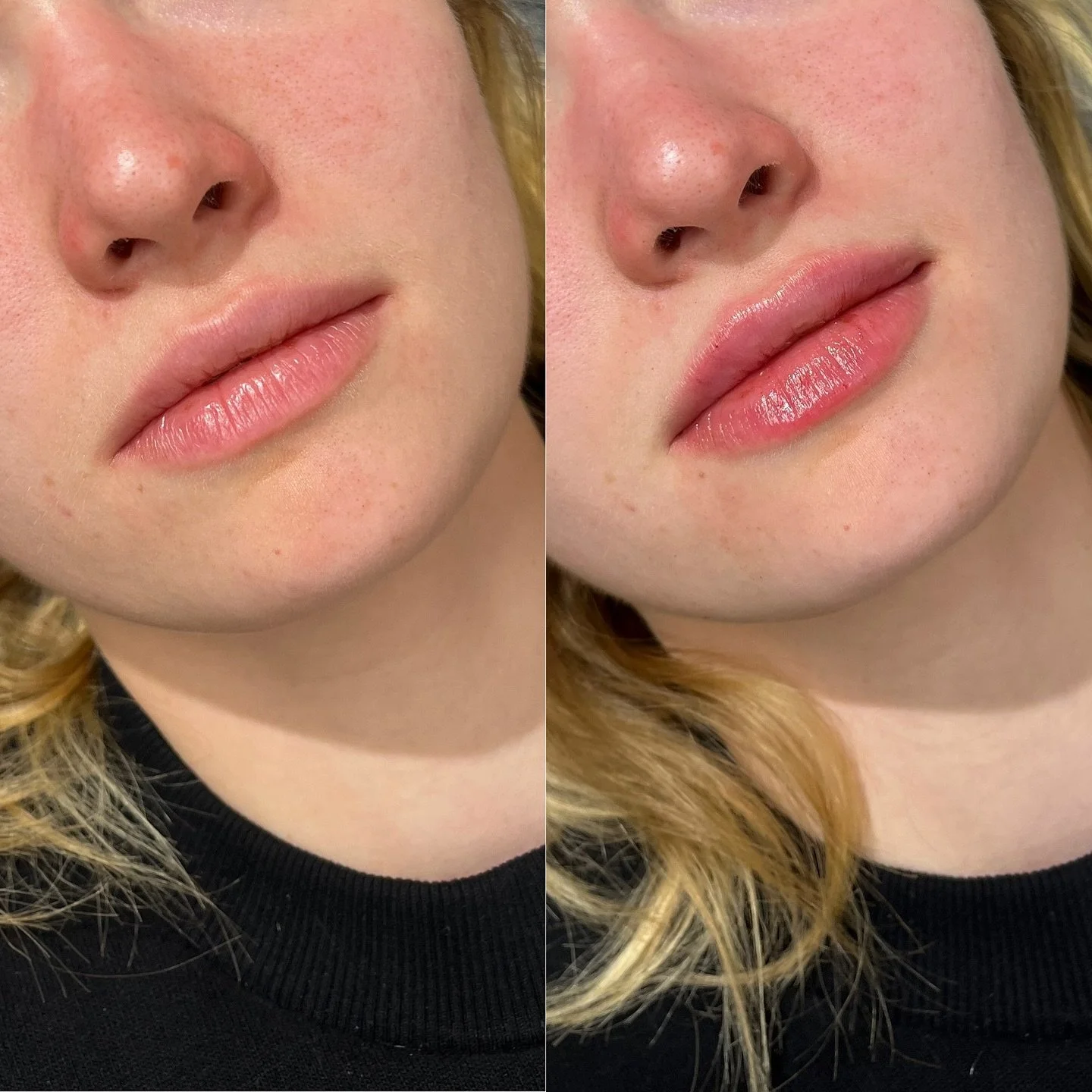 Been a minute since I&rsquo;ve posted some cute lil lipssss.❤️&zwj;🔥💋🍒

@frida.kenzie 
.
.
.
#lipfiller #dermalfiller #lips #juicylips #aestheticnurse #nurseinjector #summerlips