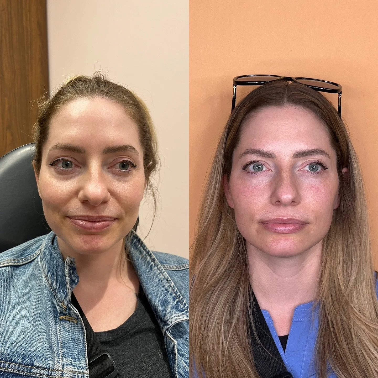 Tear trough filler is one of those treatments that most people don&rsquo;t notice until they see the before and after.

It doesn&rsquo;t make you look like a different person. It just helps soften that hollow or shadow under the eyes that can make yo