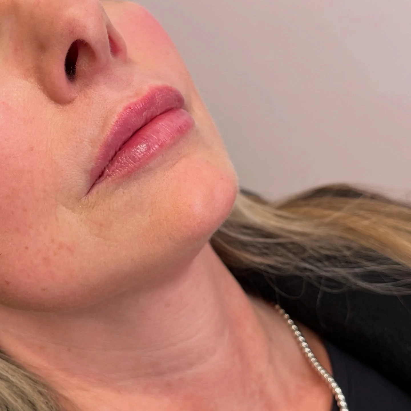 Lip Filler At Every Age &mdash; Why It&rsquo;s Not Just About Volume

Lip filler isn&rsquo;t just about getting bigger lip. It&rsquo;s about enhancing what you already have in a way that makes sense for you. And depending on your age, the approach to