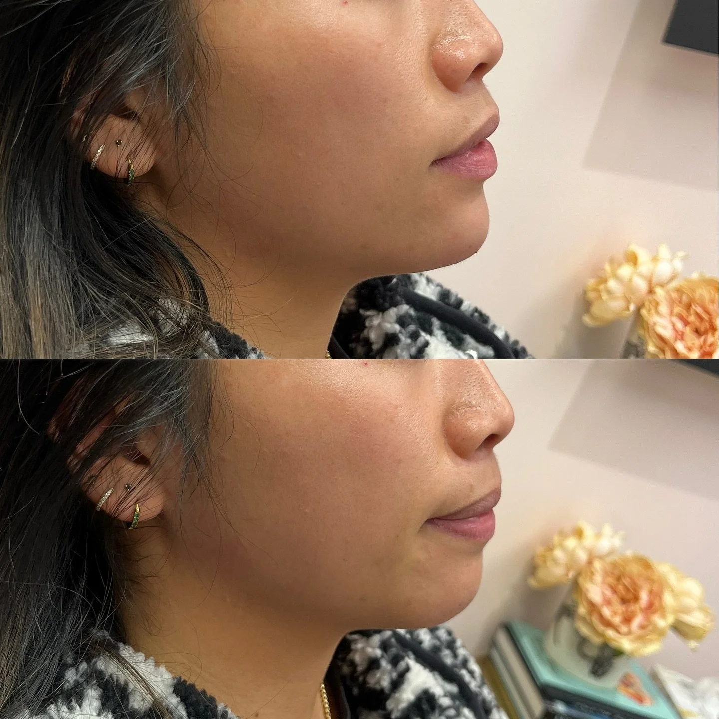 How CHIN FILLER Can Enhance Your Jawline&mdash;

If you want a more structured, streamlined jawline, you might think jawline filler is the only solution.
But here&rsquo;s a secret: for some people, chin filler alone can enhance jawline definition wit