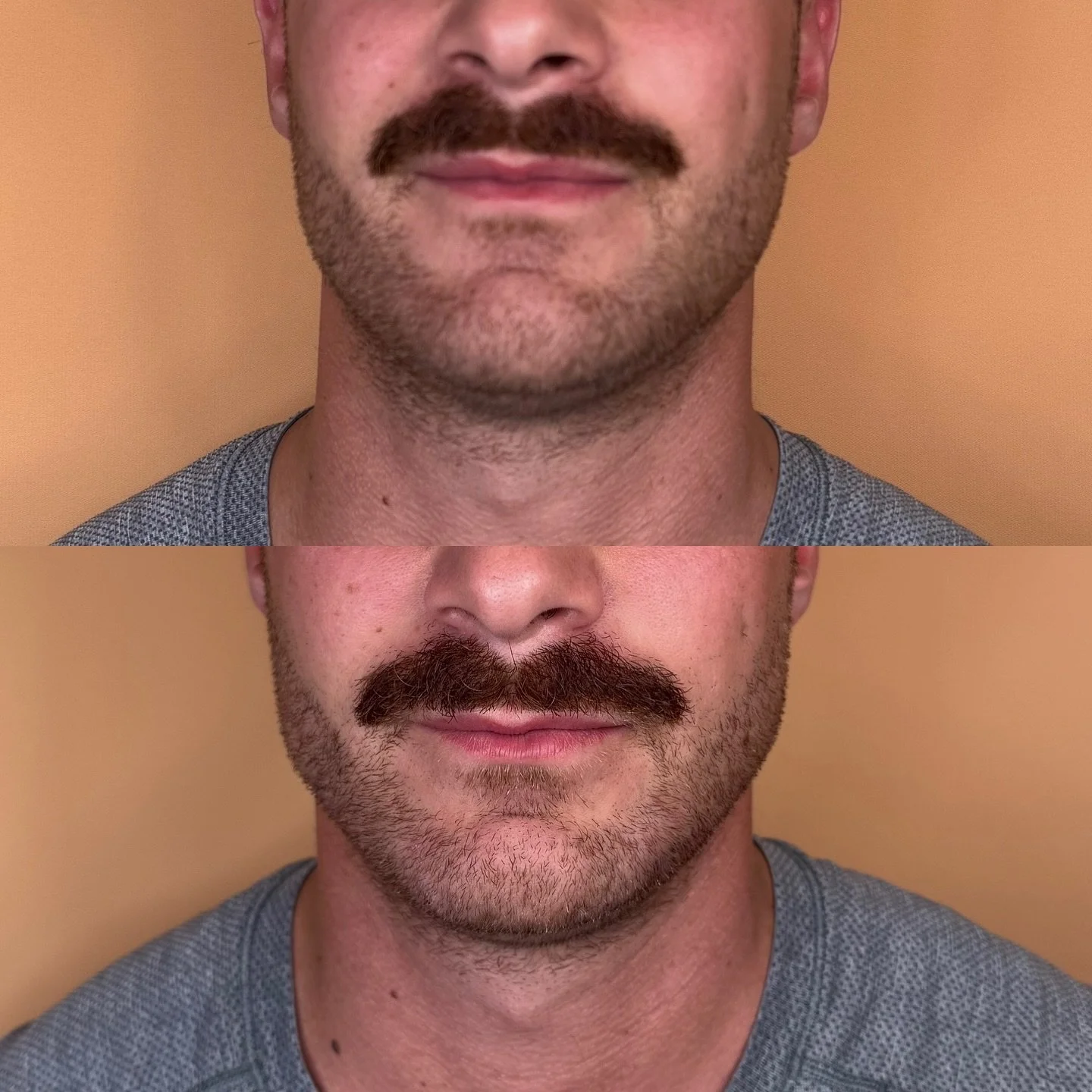 Yes - men 👏🏻 get 👏🏻 filler 👏🏻 too! 👏🏻 

Jawline definition isn&rsquo;t about changing how you look &mdash; it&rsquo;s about refining structure, improving balance, and enhancing what&rsquo;s already there.

This treatment is tailored to:
&ndas