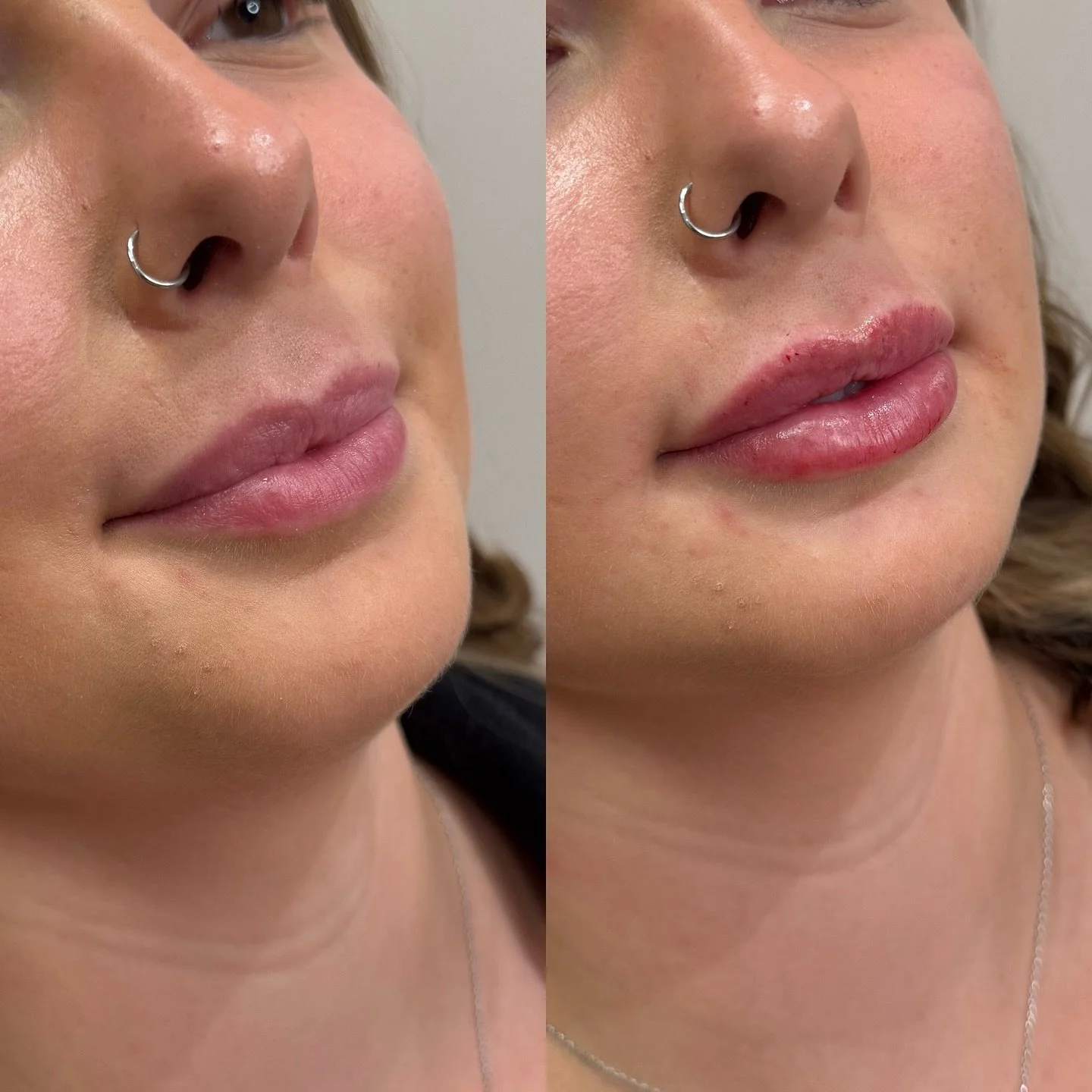 1/2 syringe filler for this cutie - slow and steady always wins the race! The goal was subtle volume, enhanced shape, improved hydration all while maintaining her natural balance✨ 

Ready to start your fall refresh? Booking link in bio 🔗
.
.