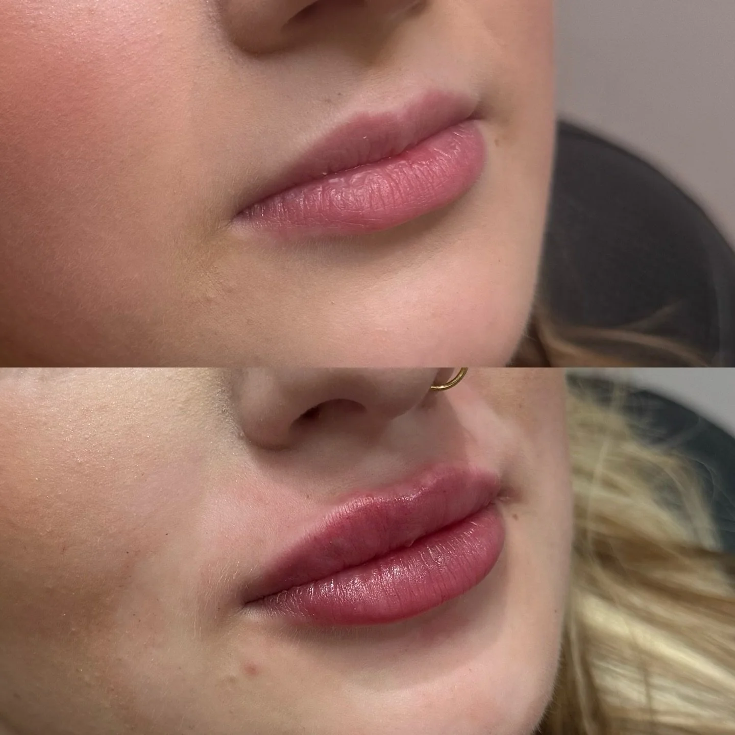 Lip filler is about enhancing what&rsquo;s already there &mdash; restoring volume, adding definition, and smoothing fine lines for a natural, balanced look. 

Results are immediate and swelling/bruising will settle within 2 weeks for lips that feel s