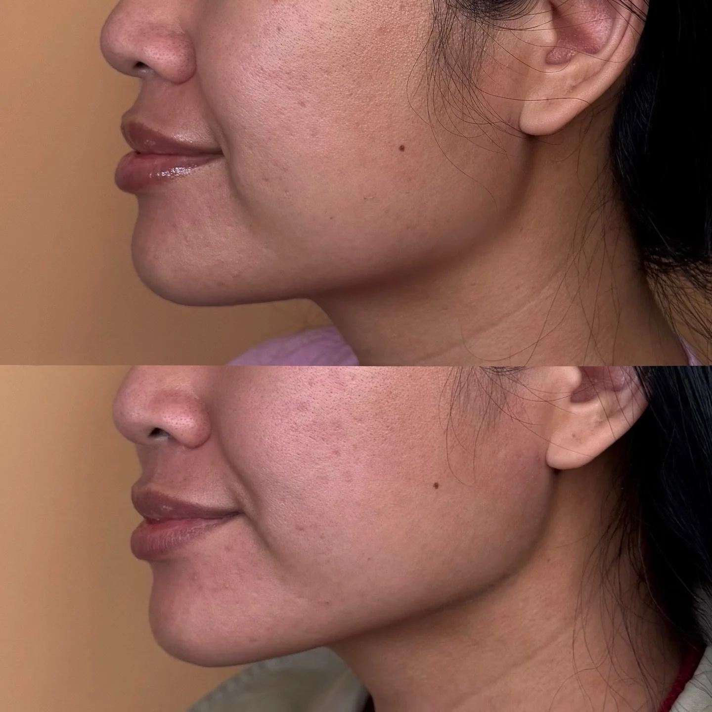 ✨ RADIESSE ✨

Before &amp; after: 3 weeks post subtle jawline enhancement using Radiesse 

This biostimulatory filler provides immediate structure support while stimulating collagen for results that can last 12&ndash;18 months or longer.

Designed fo