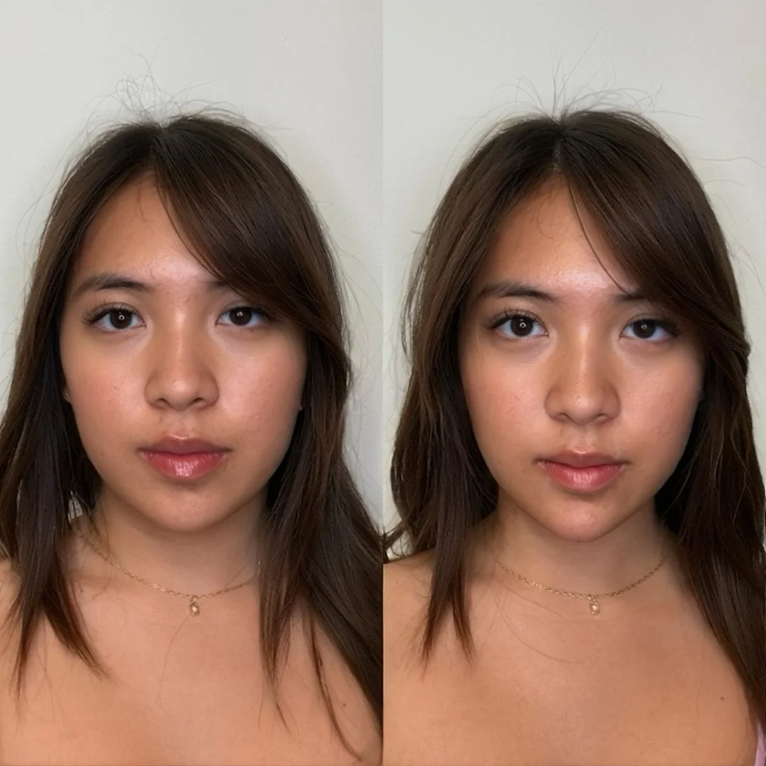 It&rsquo;s wild what a little chin filler can do🧚✨

We used 1 full syringe in this appointment to add projection and balance the lower face. It&rsquo;s amazing how much impact a subtle change to the chin can have on overall facial harmony 💉

✨Promo