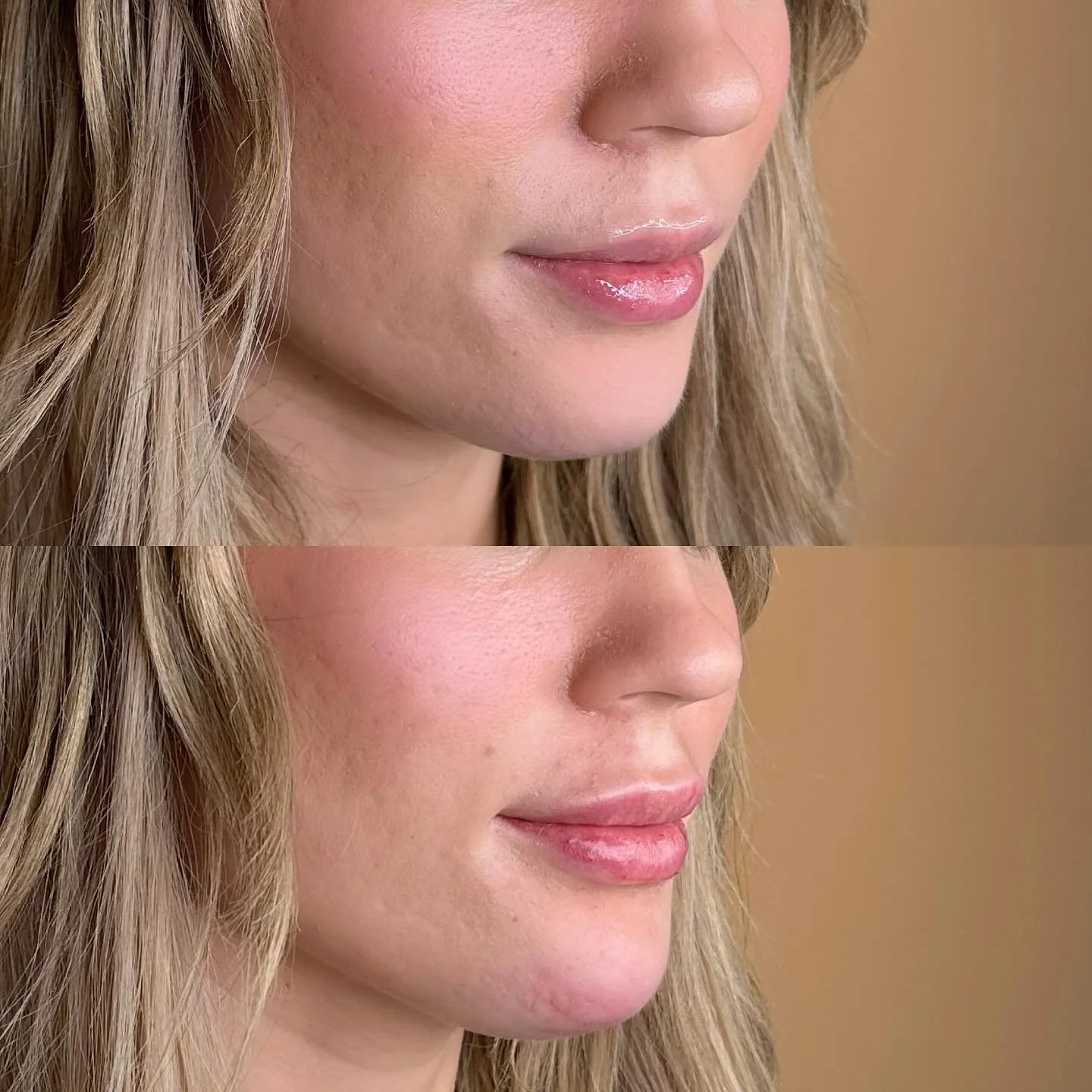 We love chin!!! So subtle but SO GOOD😻

We did one syringe of filler into the chin to create balance and more dimension for this beauty&rsquo;s gorgeous facial features. Chin filler helps elongate the face and creates a stunning contour that balance