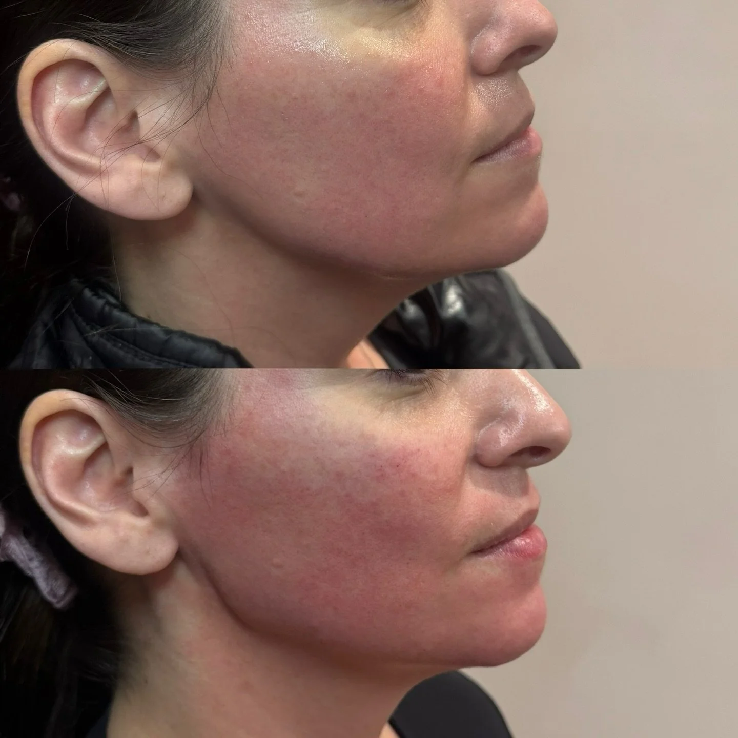✨ RADIESSE ✨

Instant definition with long-term collagen support for a firmer, more sculpted lower face. This biostimulatory filler gives structure now and continued improvement as collagen builds.

Downtime is minimal &mdash; mild swelling or bruisi