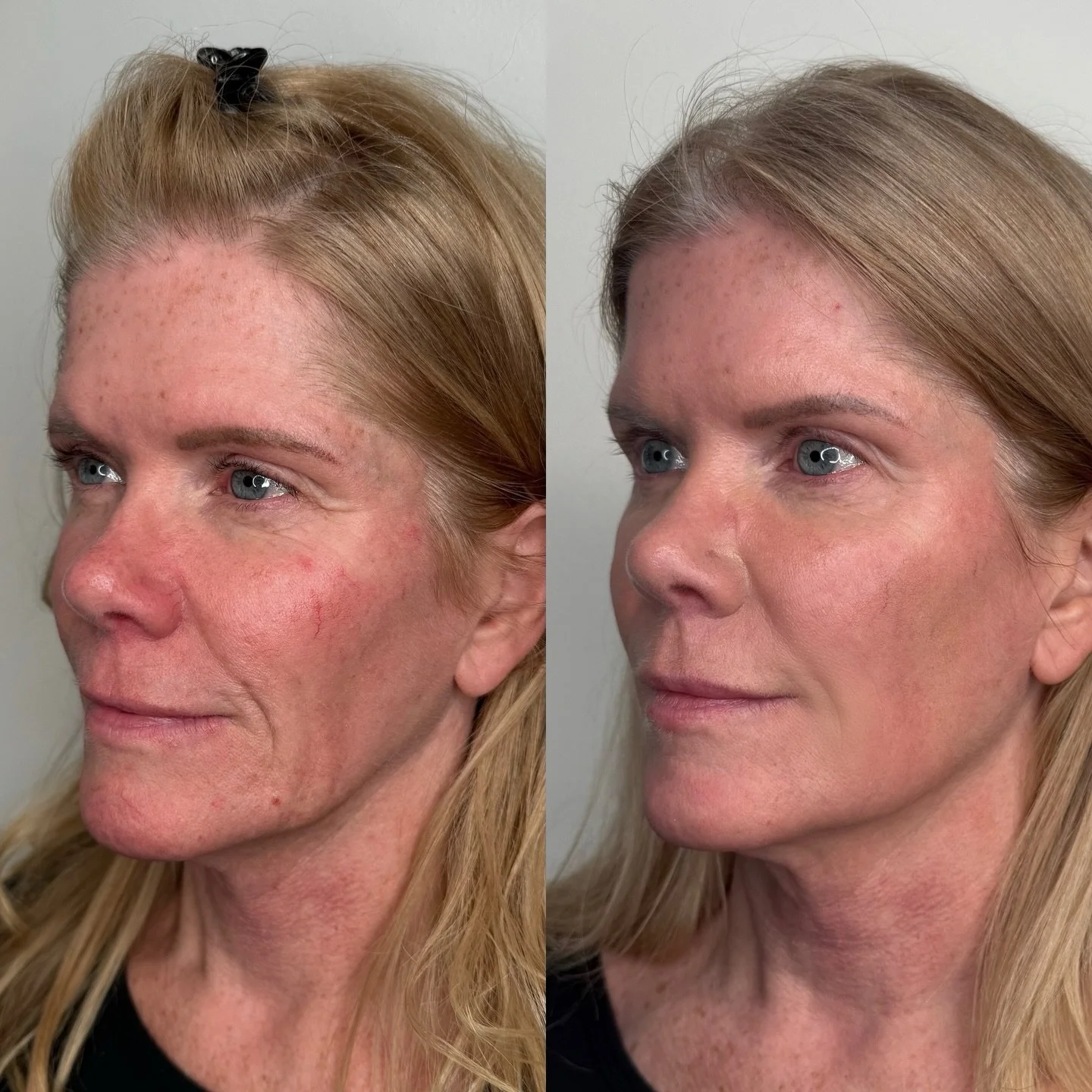does Sculptra work?? ✨

Sculptra works by stimulating your body&rsquo;s natural collagen production - improving facial structure, skin thickness, and overall support over time. Instead of an instant &ldquo;fill,&rdquo; results develop gradually for a
