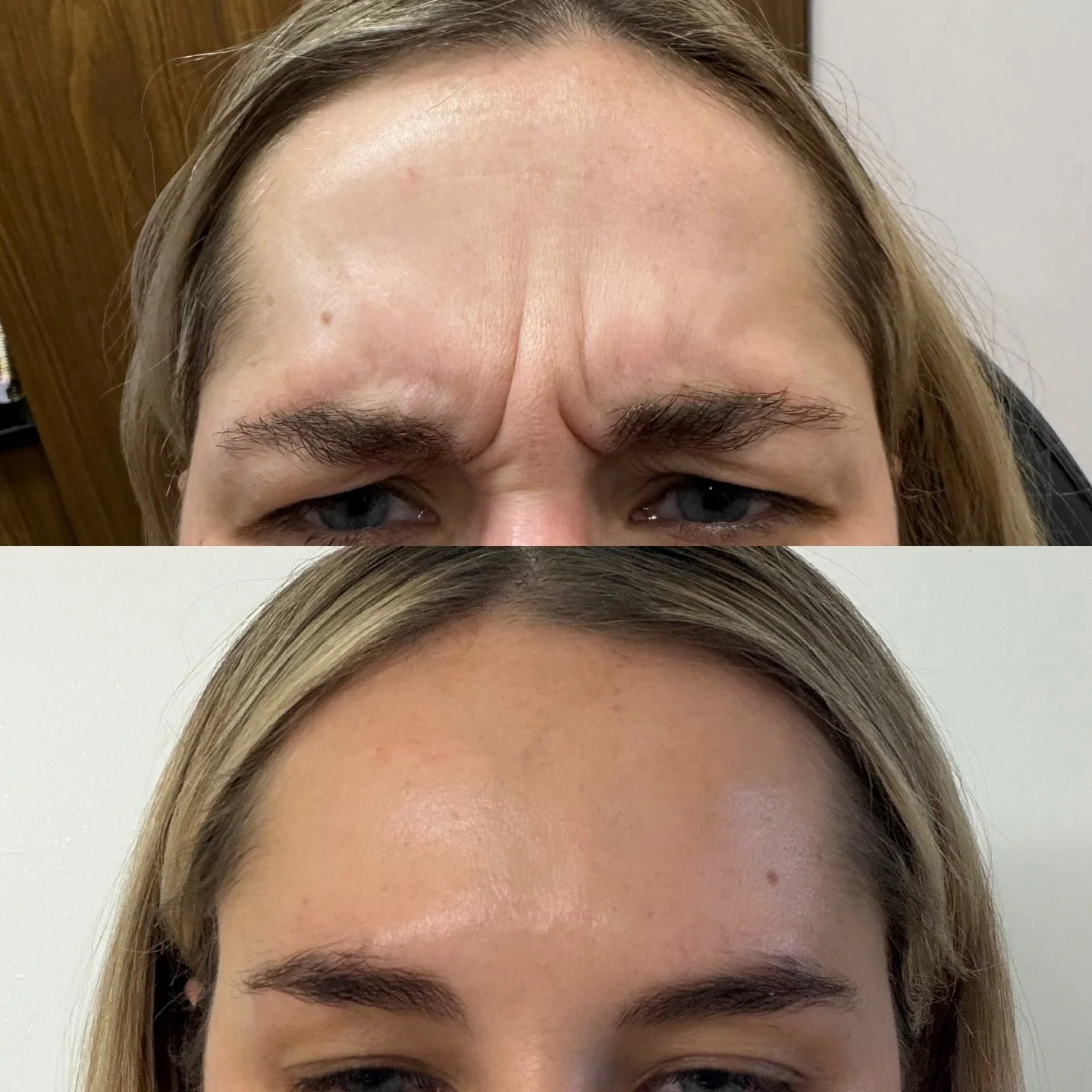 Love a smoooooth forehead 😮&zwj;💨

Customized Dysport treatment based on individual muscle strength, anatomy, and movement patterns.

Thoughtful dosing = smoother forehead and softer frown lines with natural, functional expression intact. 
.
.
#yyc