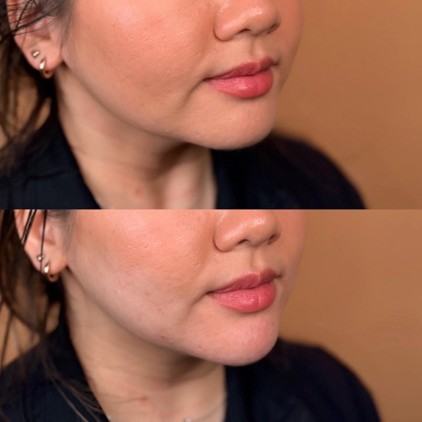 Before ➡️ After
Chin filler placed with intention to project the chin outward and soften chin shadows by blending through the pre-jowl area for a smoother profile.

✨ Masseter tox was also added to help refine and define the jawline &mdash; muscle at