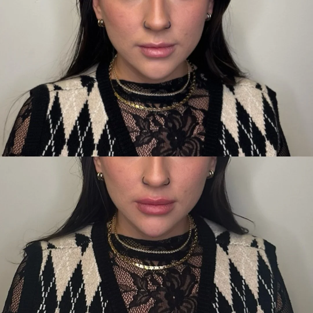 Lips &amp; chin, what a duo ✨

1 syringe to the lips to enhance volume with focus on a poutier lower lip
0.5 syringe to the chin to improve projection, balance, and overall facial harmony🧚

Love this girl and definitely going to miss her. Hoping Tor