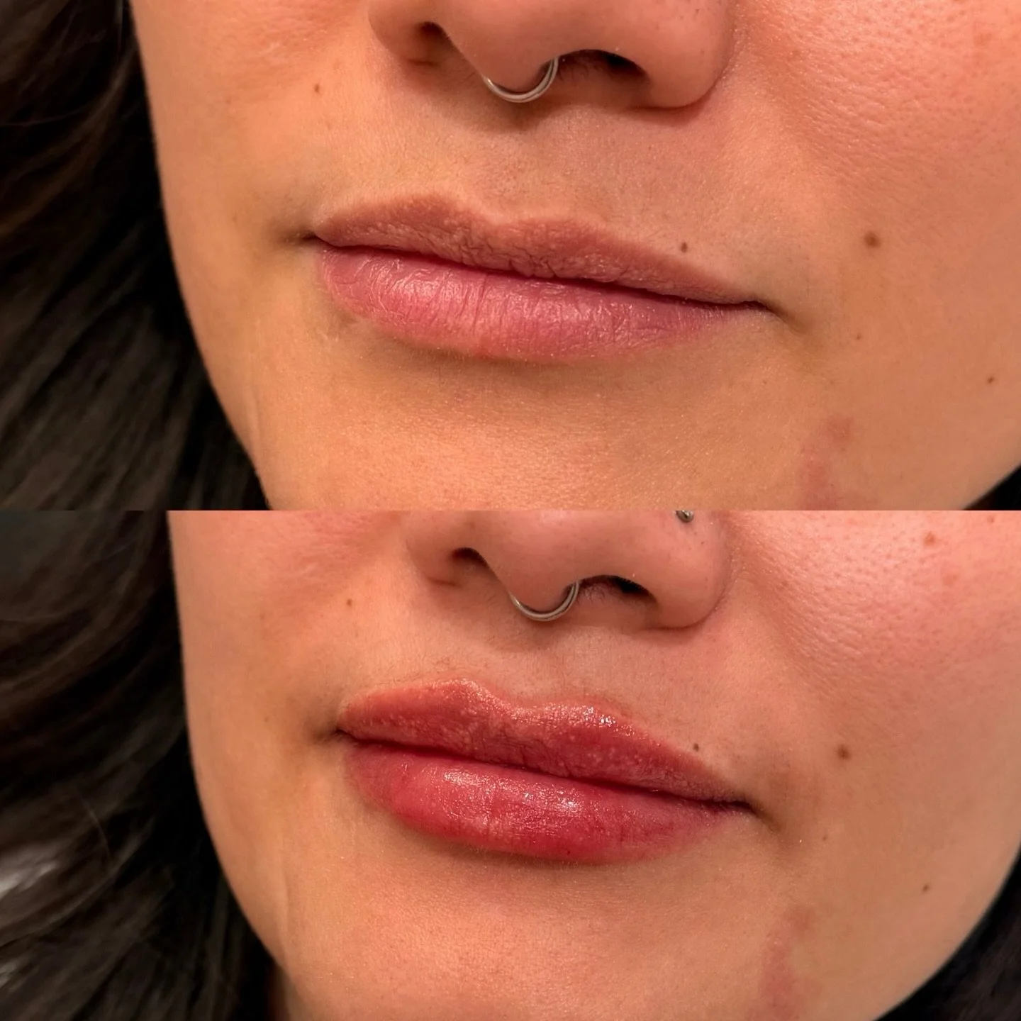 A little goes a long way 💉
Shape refined, borders supported, volume kept natural.
This is your sign that lip filler doesn&rsquo;t have to look like lip filler
.
.
.
.
#lipfillers #nurseinjector #yycaesthetics