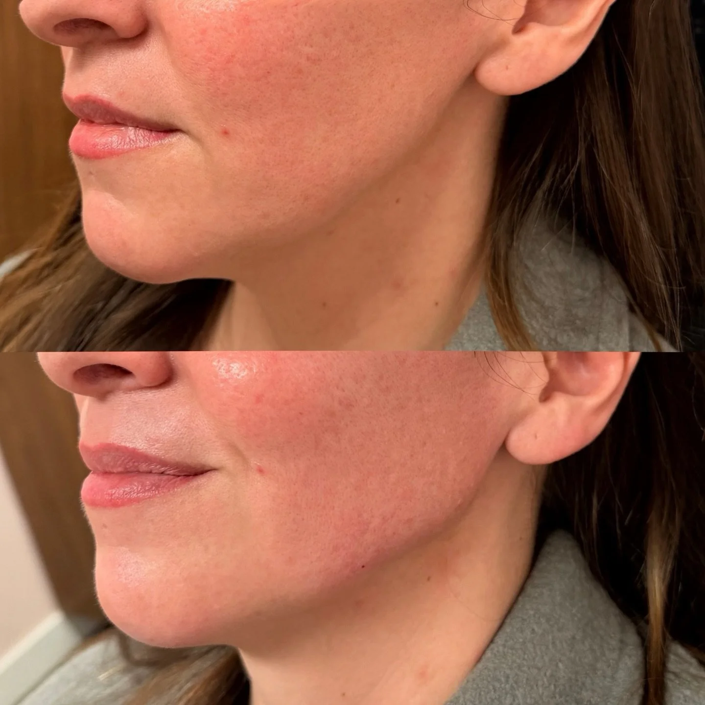 JAWLINE ENHANCEMENT 

This treatment combined Radiesse for precise jawline contouring with a subtle touch of chin filler to achieve facial harmony.

✨ How Radiesse works:
&bull; Provides immediate lift and definition
&bull; Stimulates natural collage