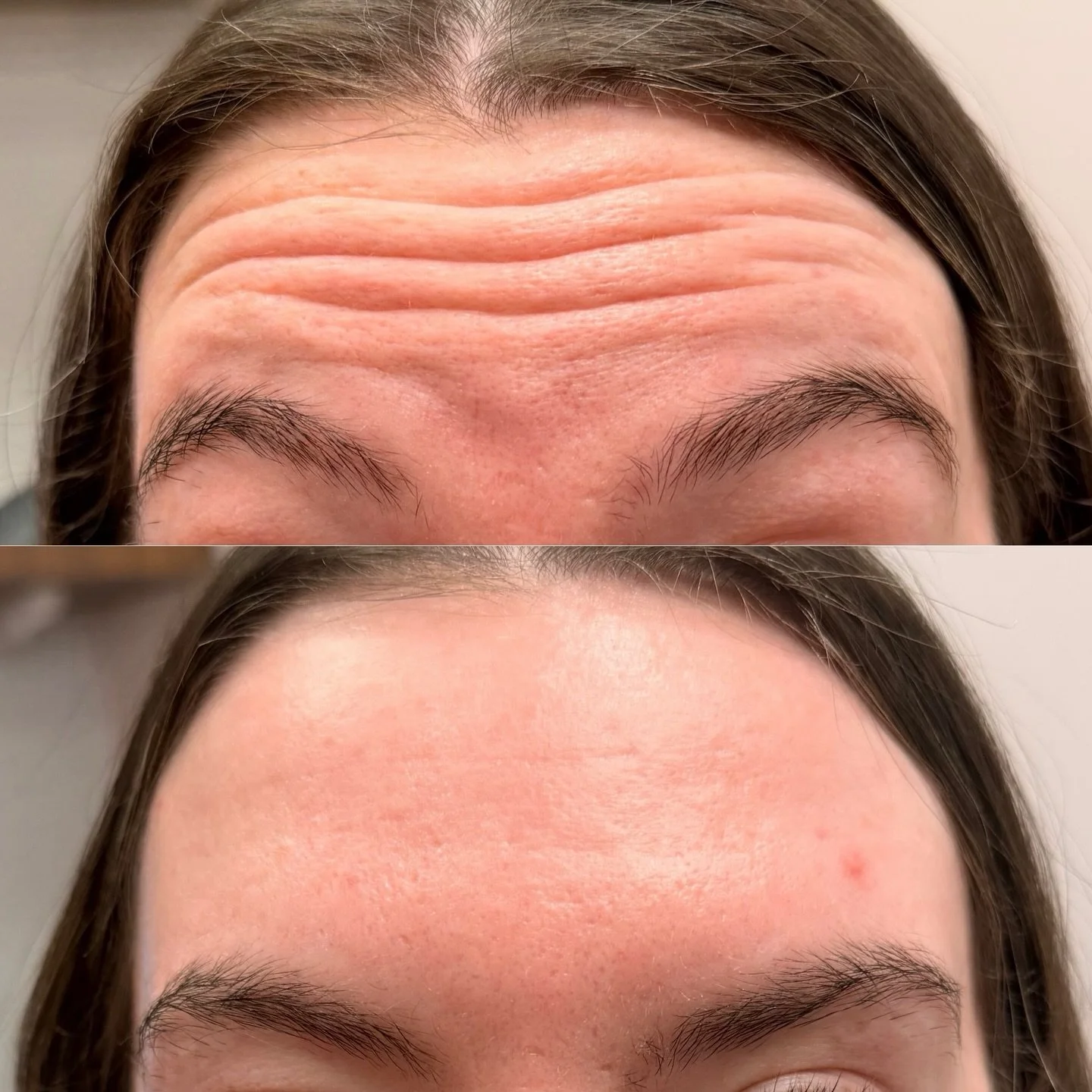 always obsessed with a smooooth forehead 🤩 

Every treatment starts with an individualized assessment of dynamic movement and muscle strength&mdash;because no two faces move the same.
Strategic dosing allows us to soften lines while preserving natur