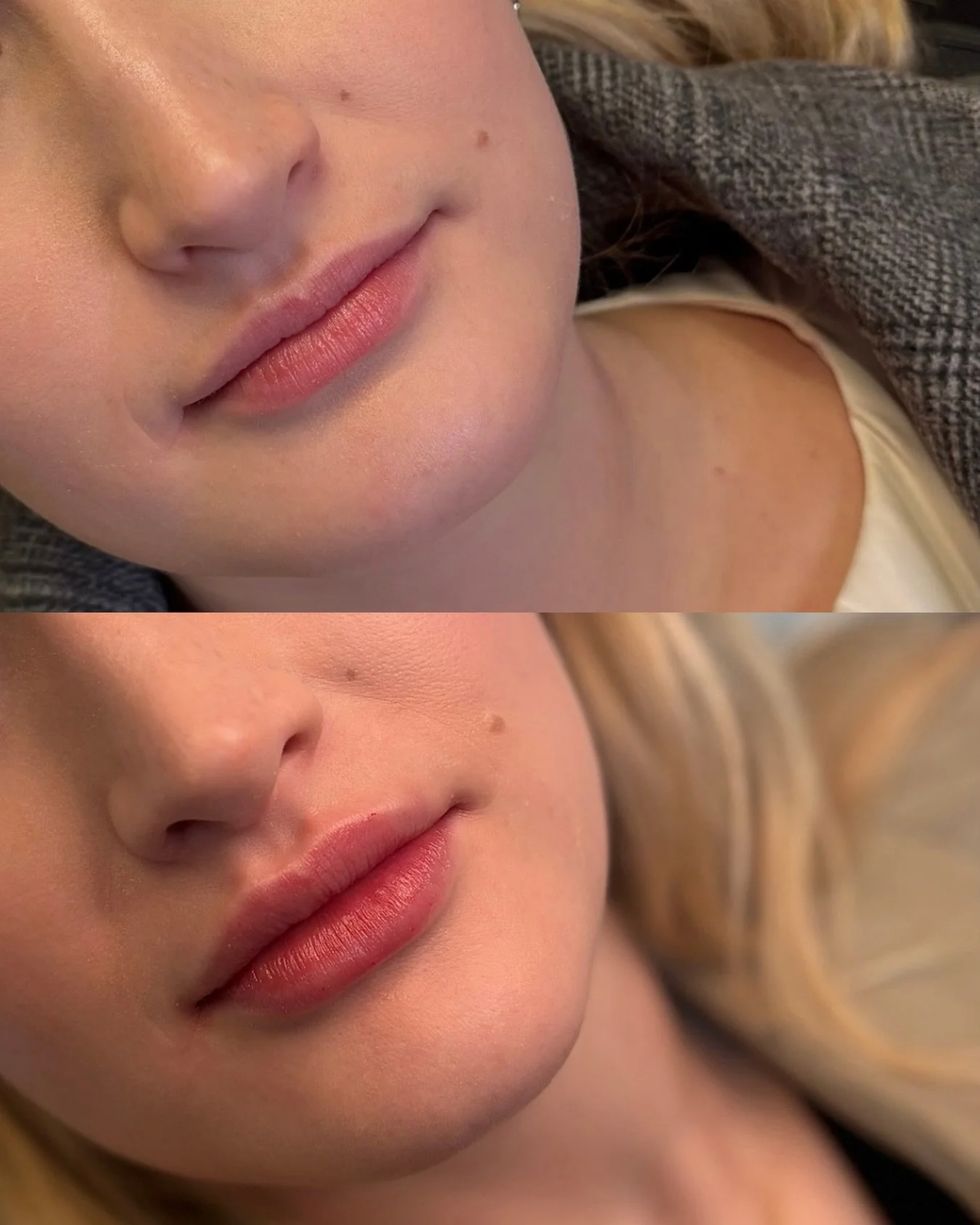 A lil extra oomph ✨

We built this look over two sessions, starting with 1/2 syringe, then going in with a full to add a little more volume while still maintaining her naturally gorgeous shape 👄

&bull;

&bull;

&bull;

@frida.maura.selleck