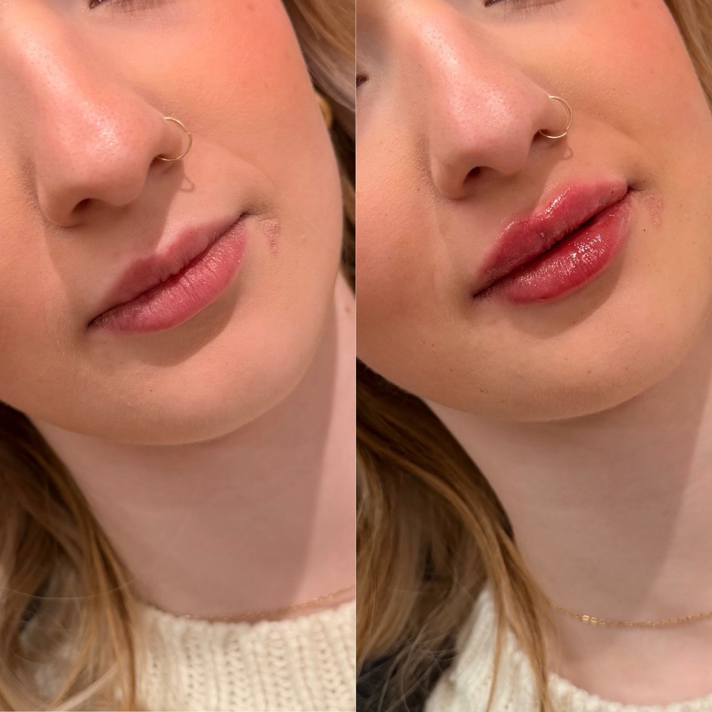 If you&rsquo;ve been thinking about 👄&hellip; this is your sign!

Book your consultation today to discuss your aesthetic goals &mdash; link in bio! 
.
.