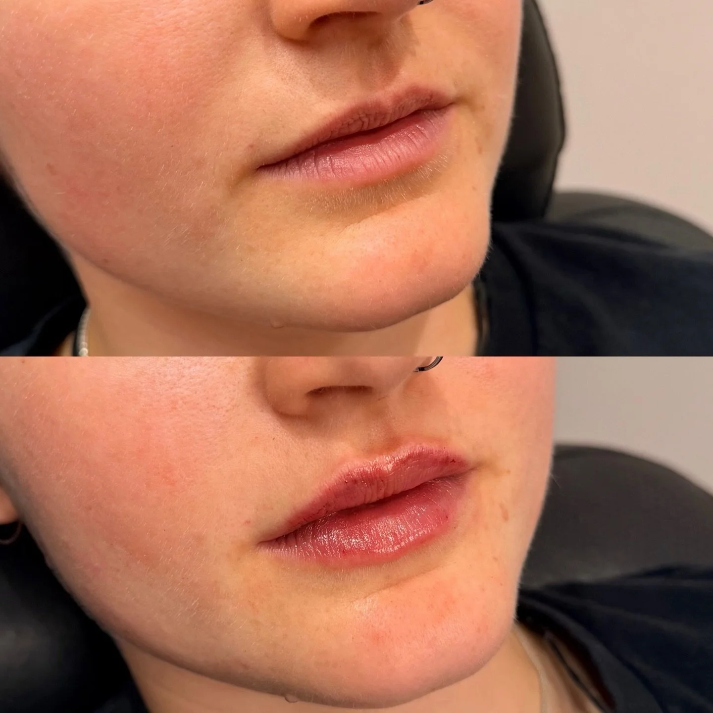 a little mini lip plump is always a good idea 🤩 

Benefits include: 
&bull; restores lost volume over time
&bull; enhances natural shape + symmetry
&bull; hydrates + smooths fine lines
&bull; subtle, buildable results (your lips, just better)
&bull;