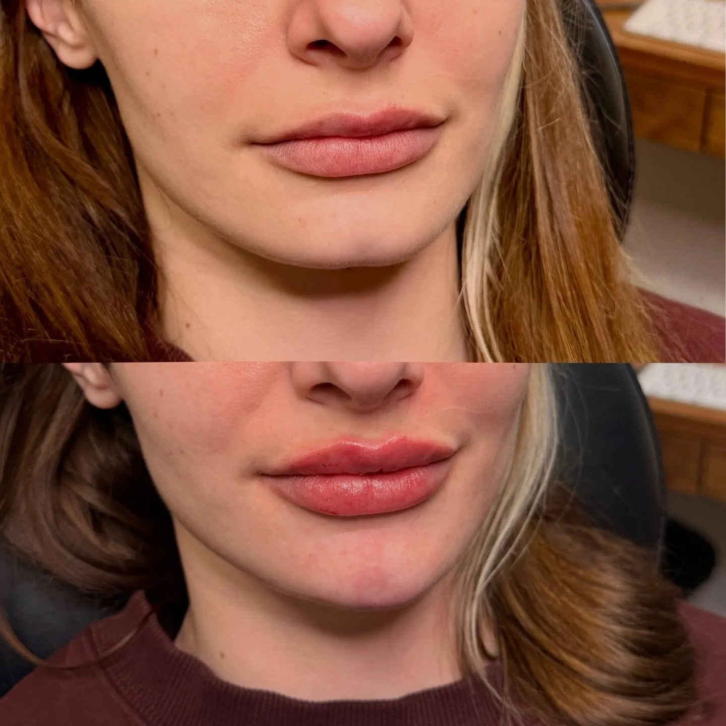 It&rsquo;s not always just about the lips 👀

Sometimes what&rsquo;s missing is a little chin projection to help balance it all! 

Think:
&bull; Harmonized lower face
&bull; A more defined, sculpted profile
&bull; Lips that actually fit your features