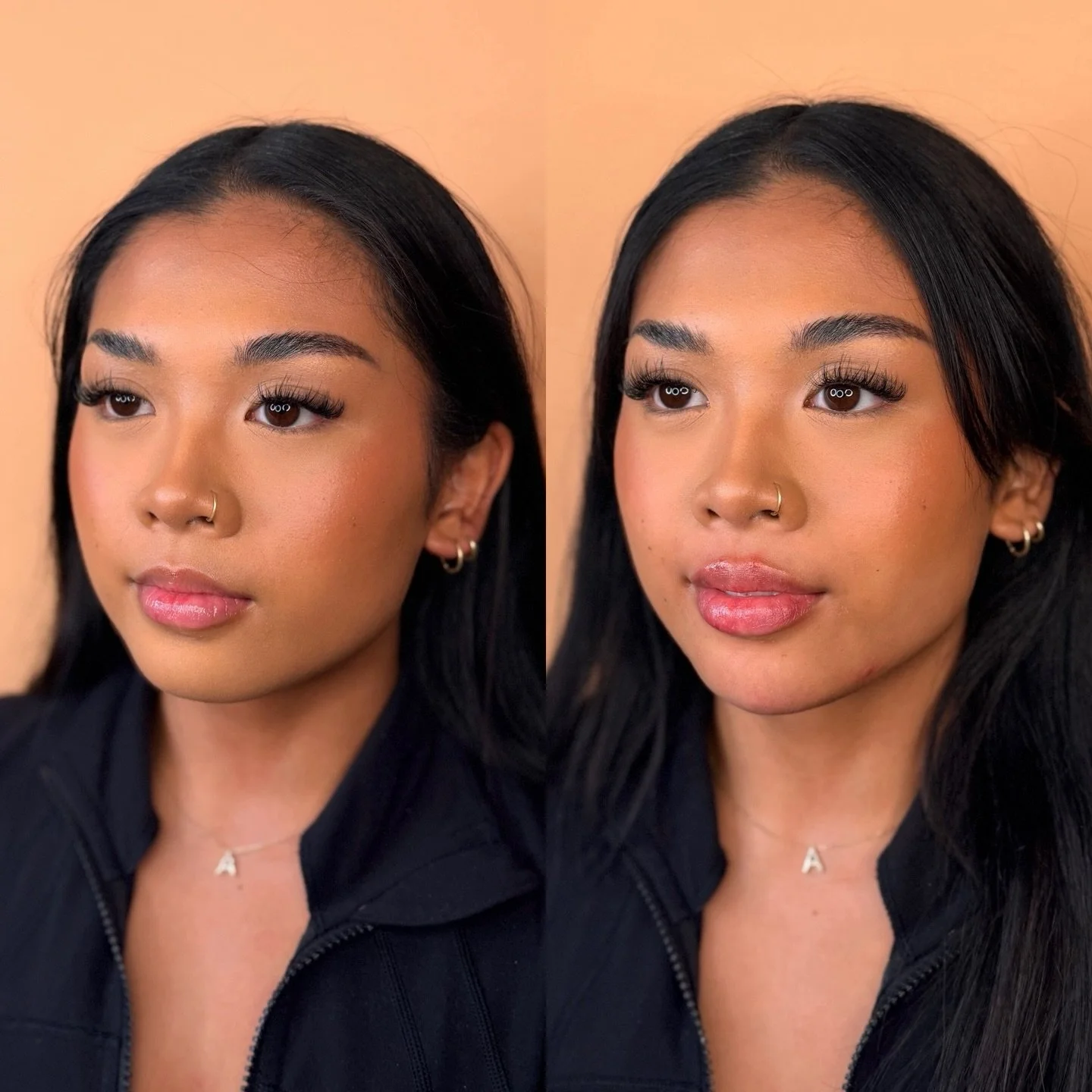 Balanced, refreshed, and still you ✨

Chin + lip filler is one of our favourite combo treatments for creating facial harmony&mdash;improving profile balance, adding chin support, and enhancing lip shape and definition without looking overdone.

The r