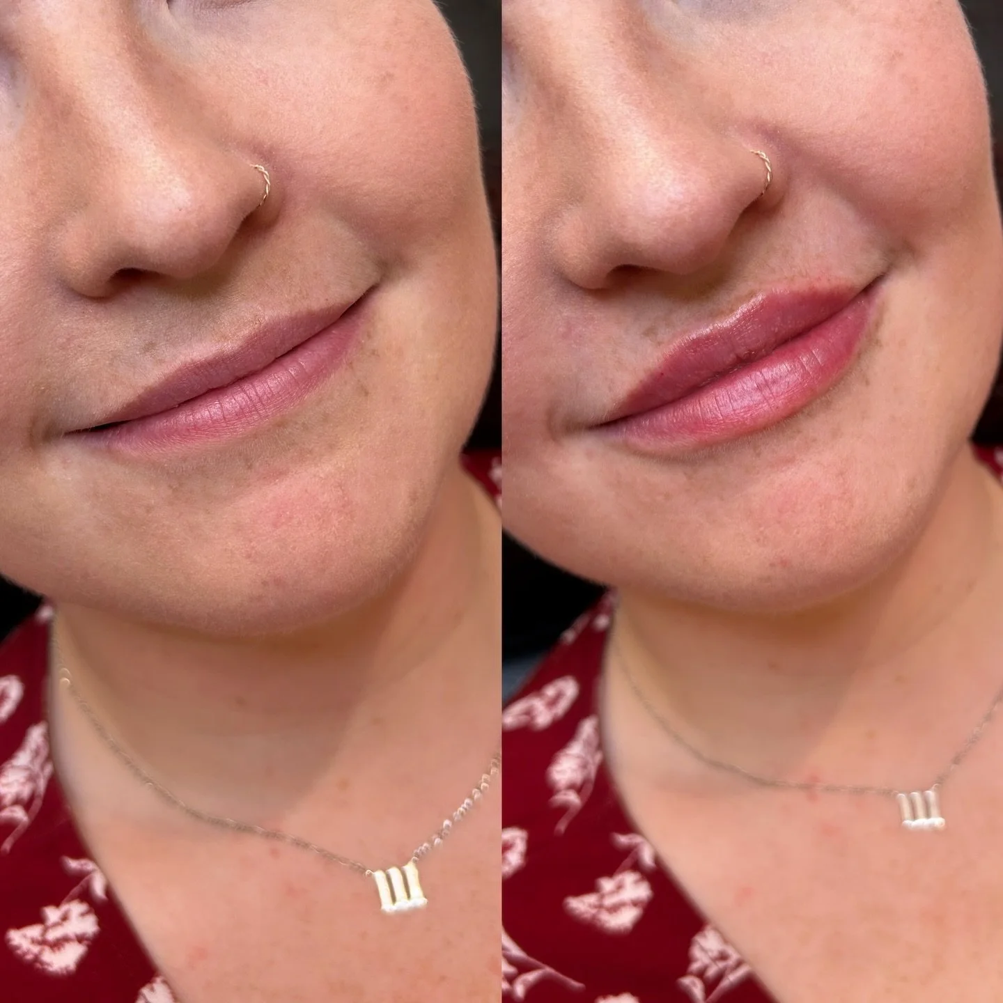 OH OKAY 😍

Lips by me . 

#yyclips #lipfilleryyc #lips #halfsyringe #lipfillers