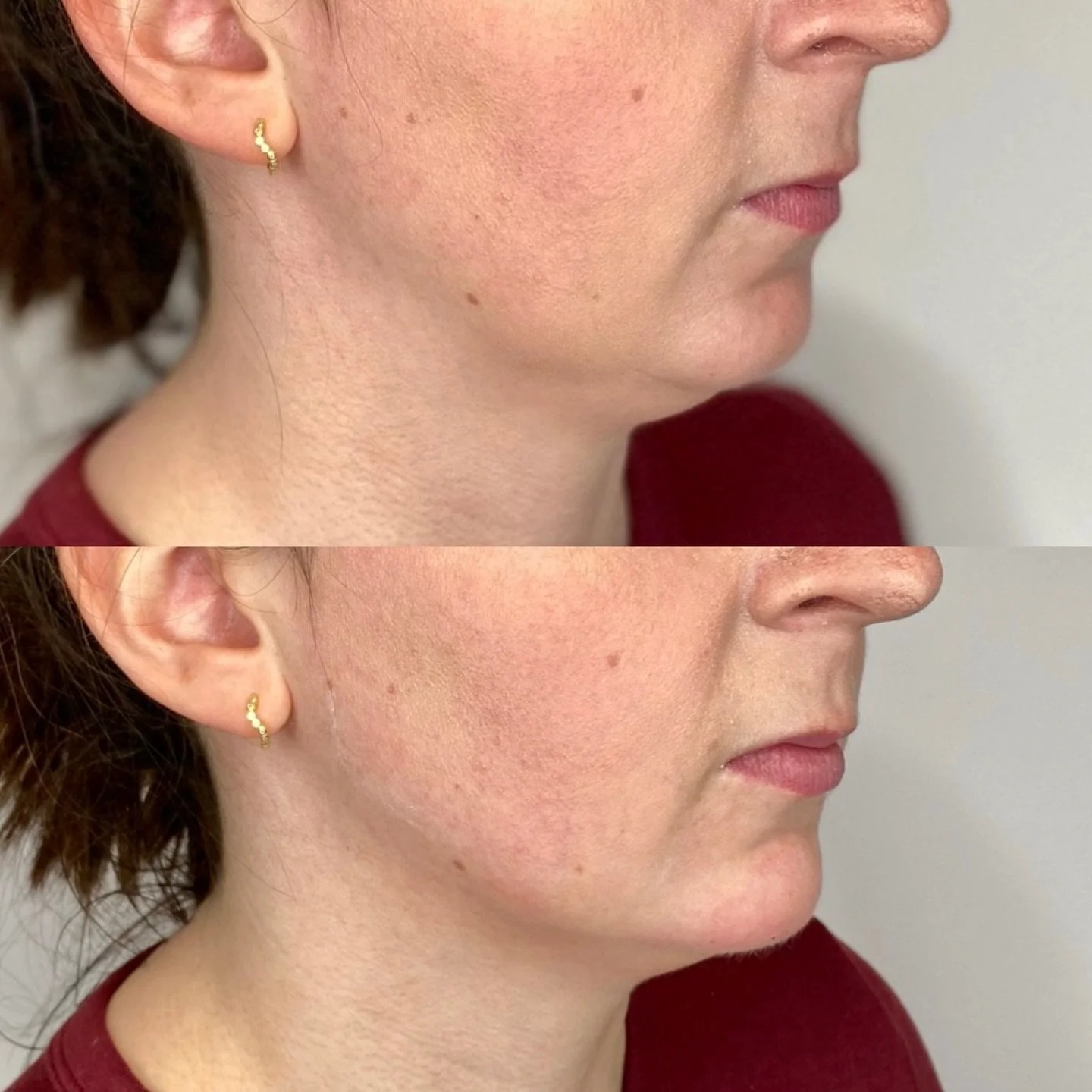 Strategic placement of filler to blend and project 😮&zwj;💨

Chin &amp; anterior jawline done by me 🪄