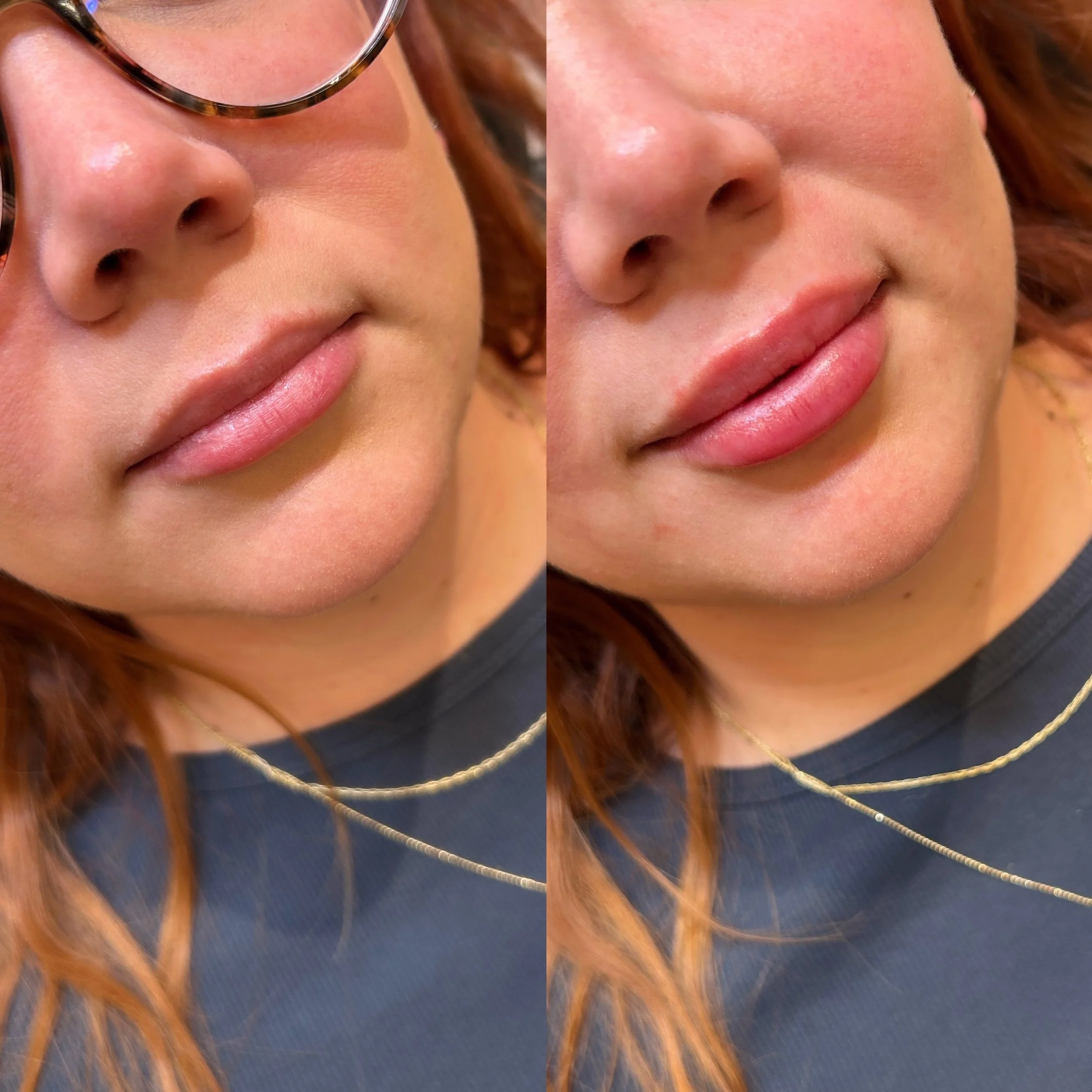 Why lips are my favourite treatment 😮&zwj;💨 

#fridabeautybar #lipfilleryyc #yyclipinjections #lipinspo #yyclipfiller