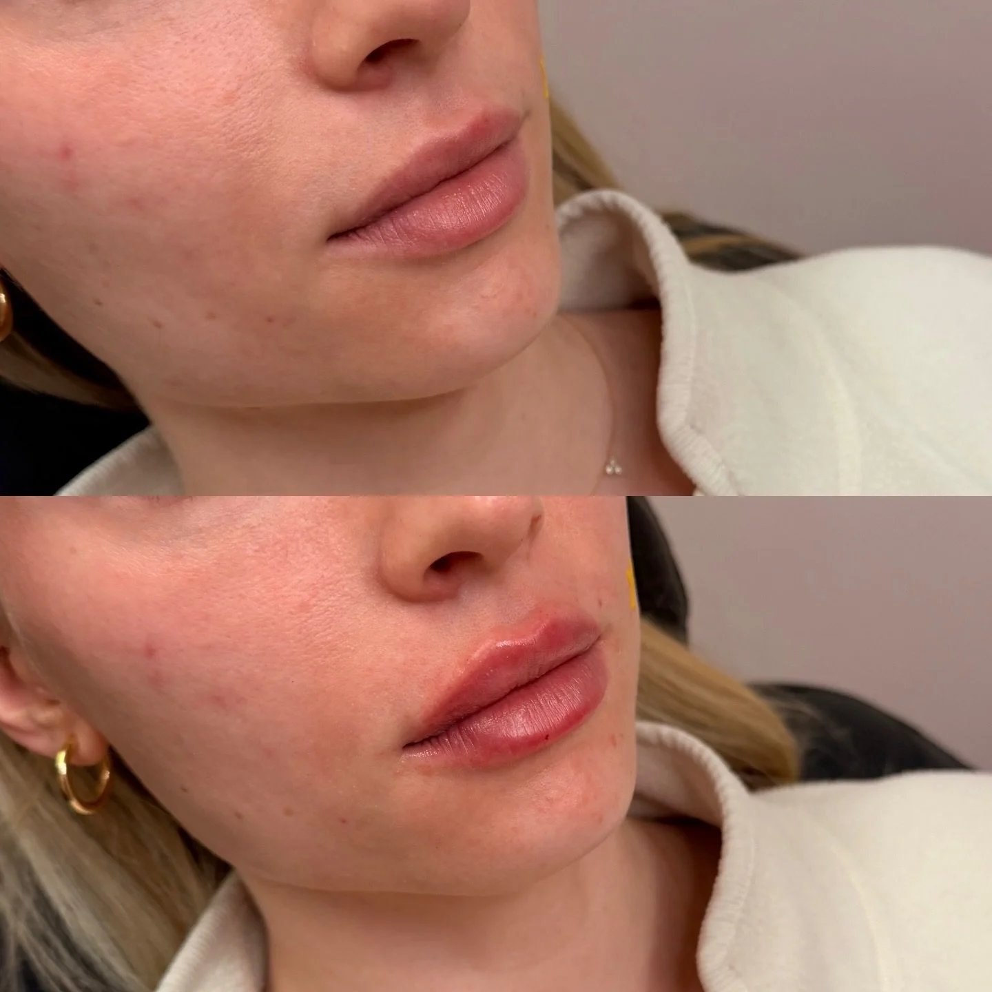 Placement > volume. Always.

Soft structure, improved hydration, and balance that actually fits your face&mdash;not trends.

Lip filler can:
&bull; Define the border without looking &ldquo;done&rdquo;
&bull; Improve symmetry + proportions
&bull; S