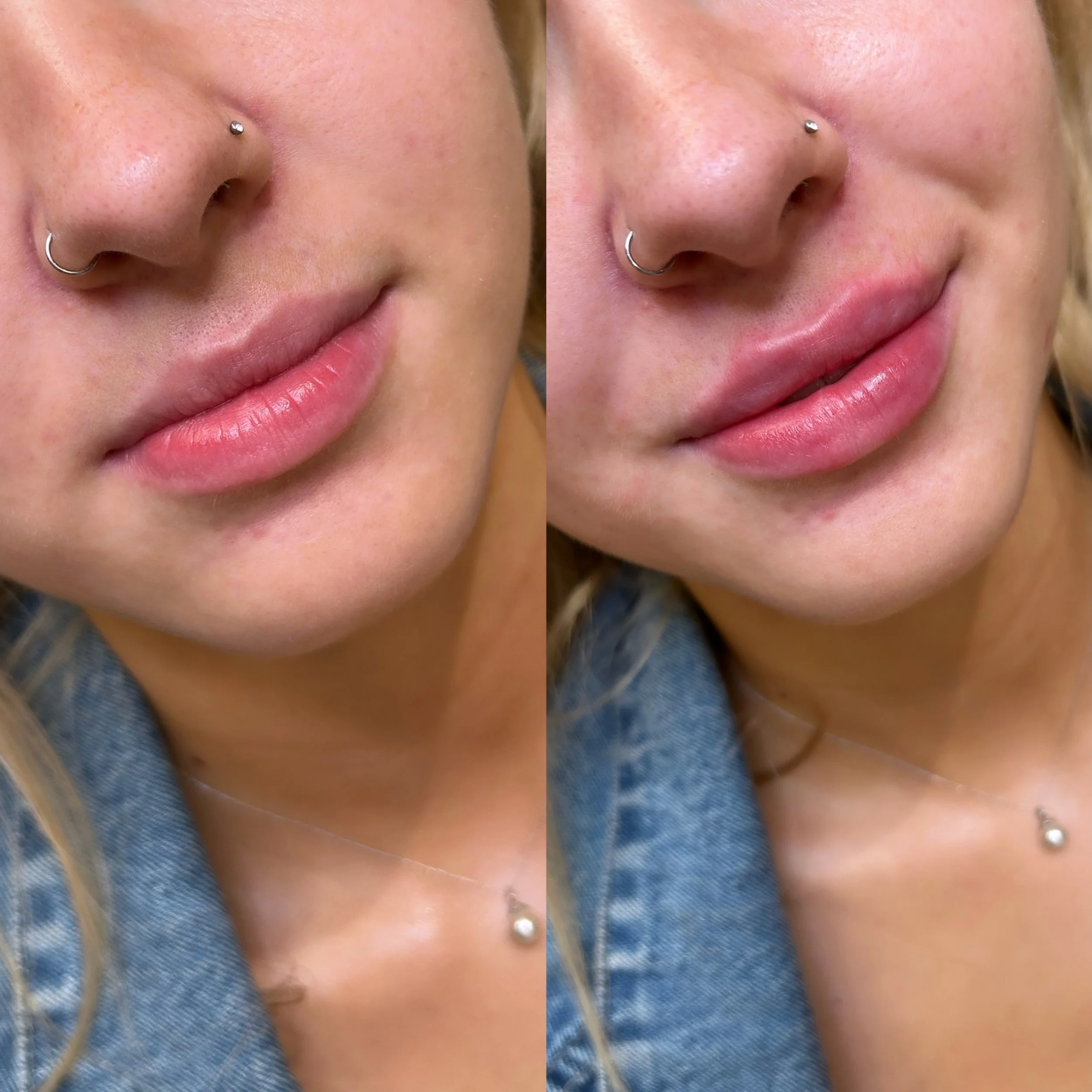 1/2 syringe for symmetry &amp; hydration 🍉