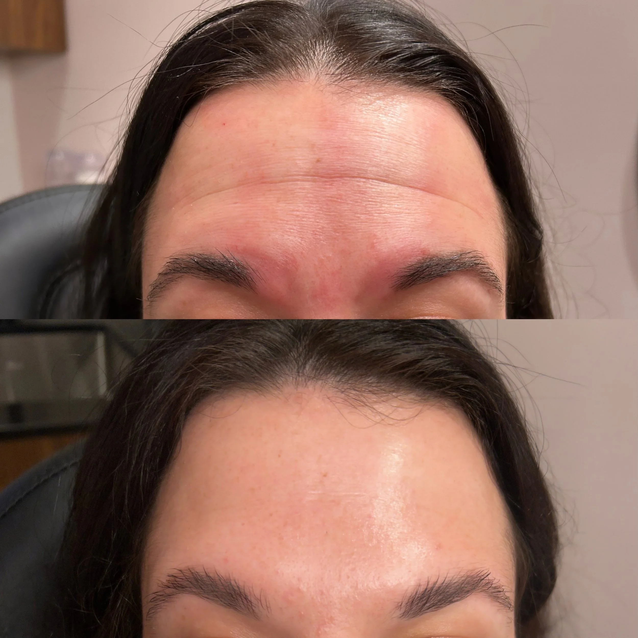 first treatment to soften horizontal forehead lines, I would say we were successful 😍