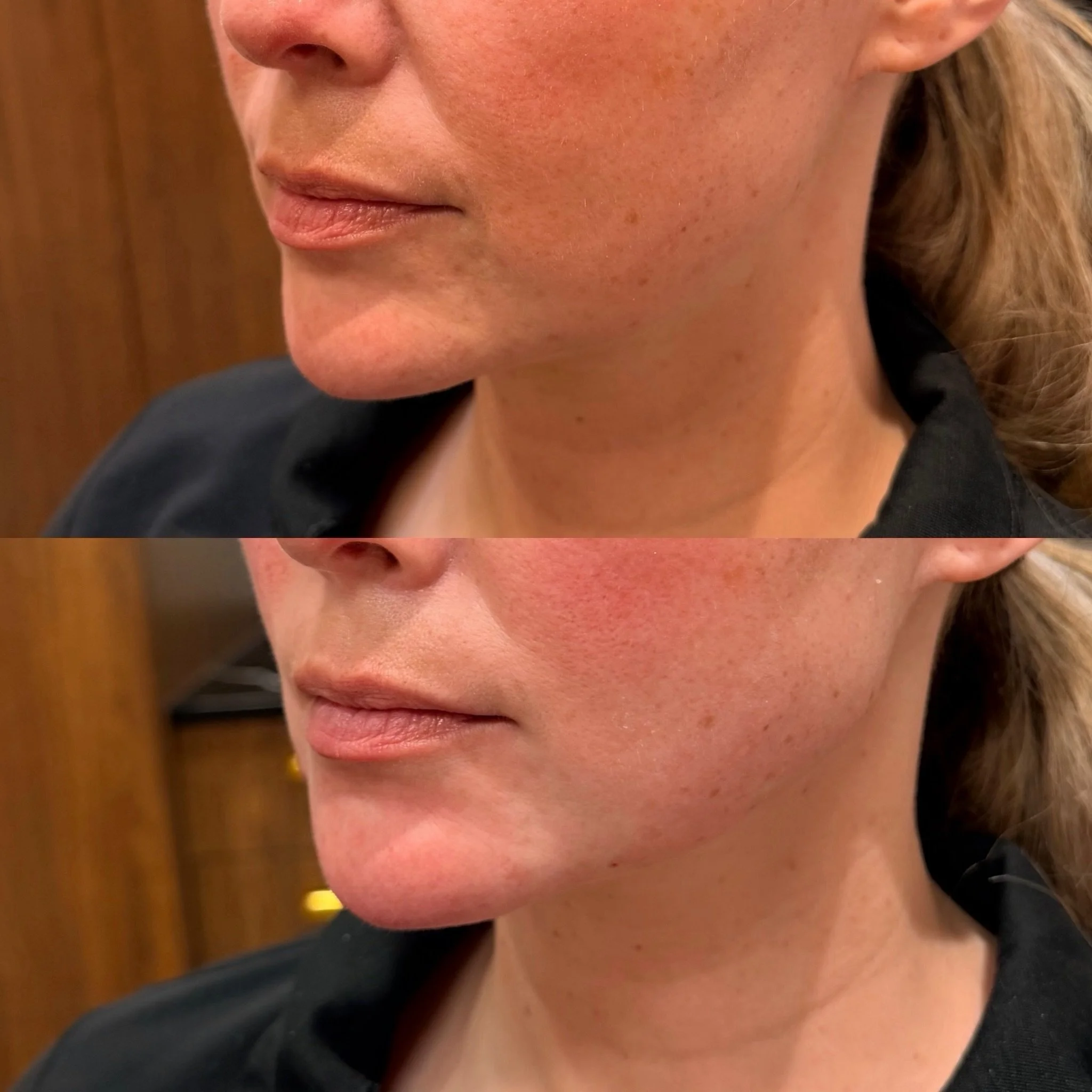 lower face balancing using HA filler ✨

Strategically treated the chin shadow, jawline, and marionette area to create smoother transitions, improve facial harmony, and restore support through the lower face.

The goal? Subtle structure, better balanc