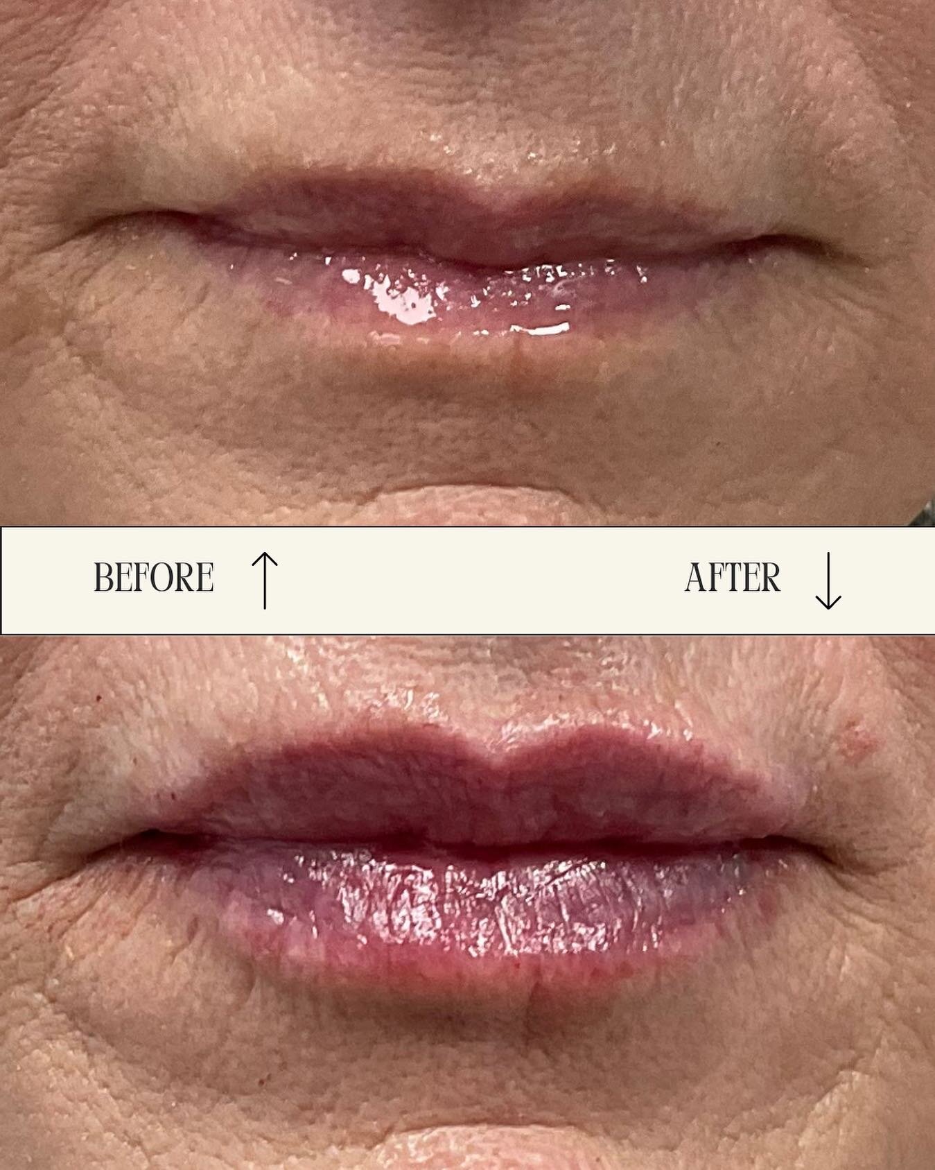 This client expressed concern for lip thinning and uneven lip shape. We were able to embrace the beauty of aging by using lip filler to restore her volume loss and carefully redefine the lip border for a more symmetrical and youthful smile!