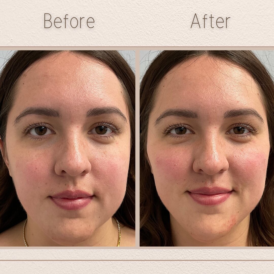 This was my client&rsquo;s first time getting filler. The goal was to create a more balanced contouring of her face with focus on the cheek and chin area. Her before and after shows just how subtle and natural appearing facial filler can be.