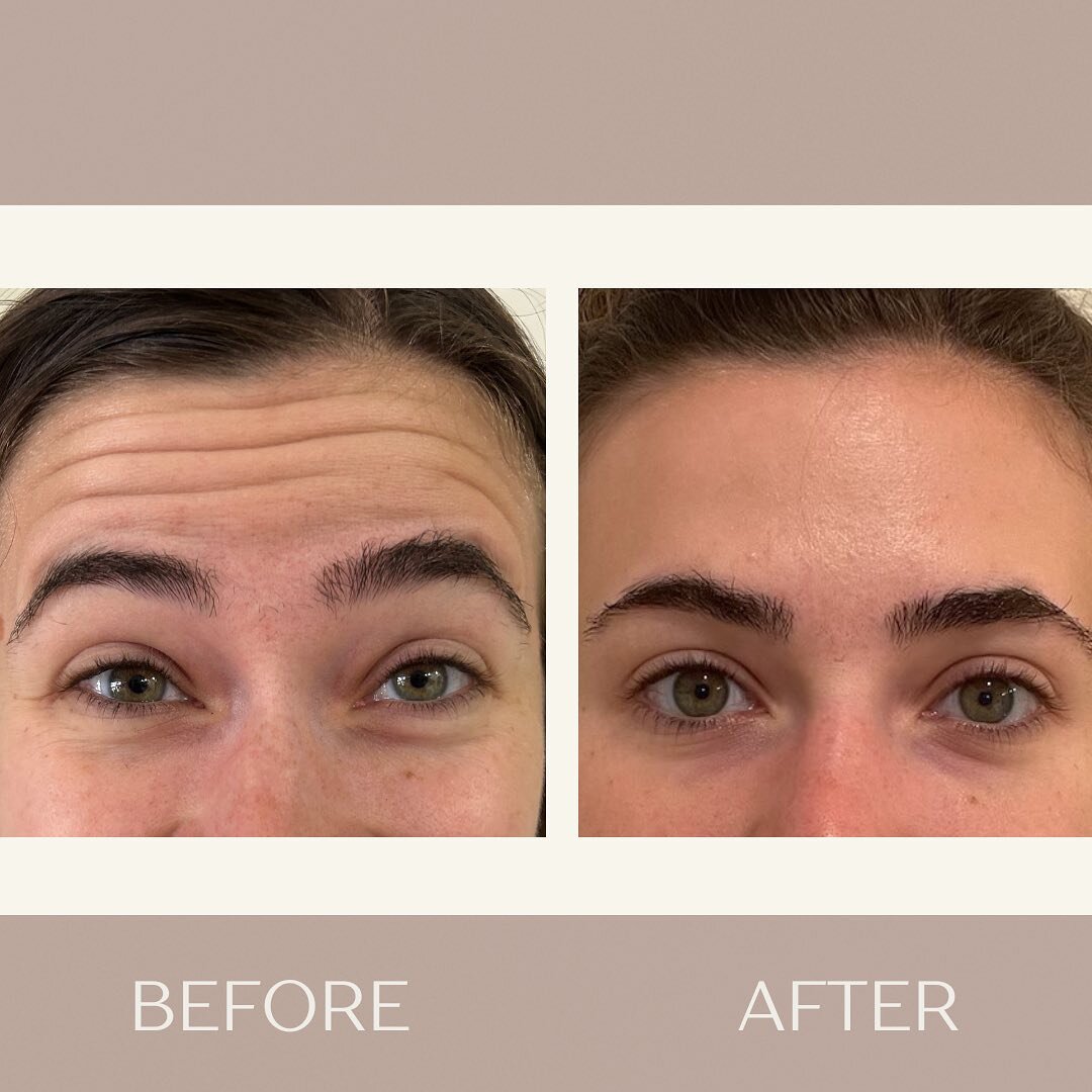 Preventative Botox is a strategic step to fend off future deep-seated wrinkles by managing facial muscle activity. This young woman was an ideal candidate for discussing preventive treatment. 

At 27, she shares concern of faint lines appearing on he
